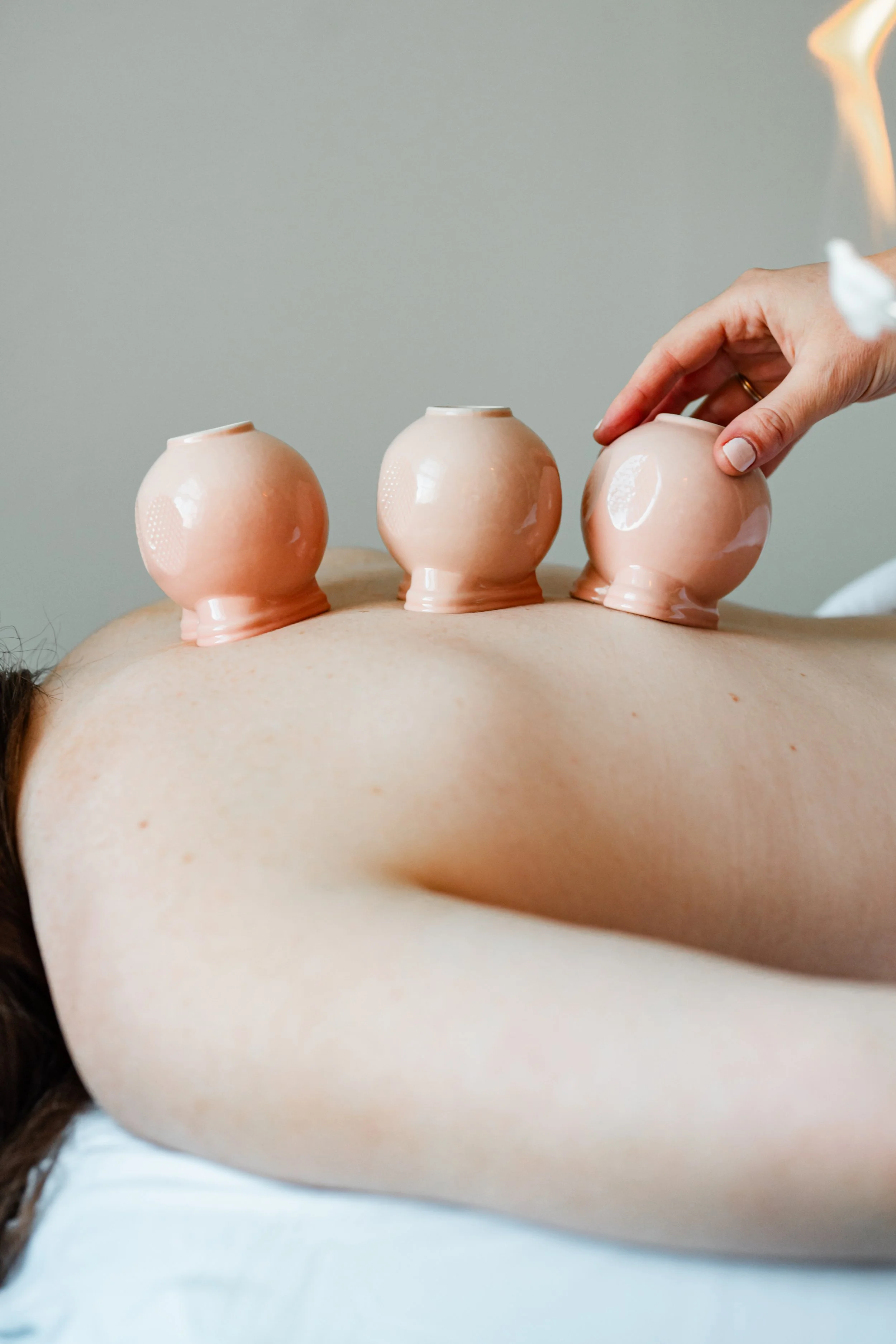 Multiple cupping cups placed on the back for chronic pain relief during acupuncture in Groton, MA