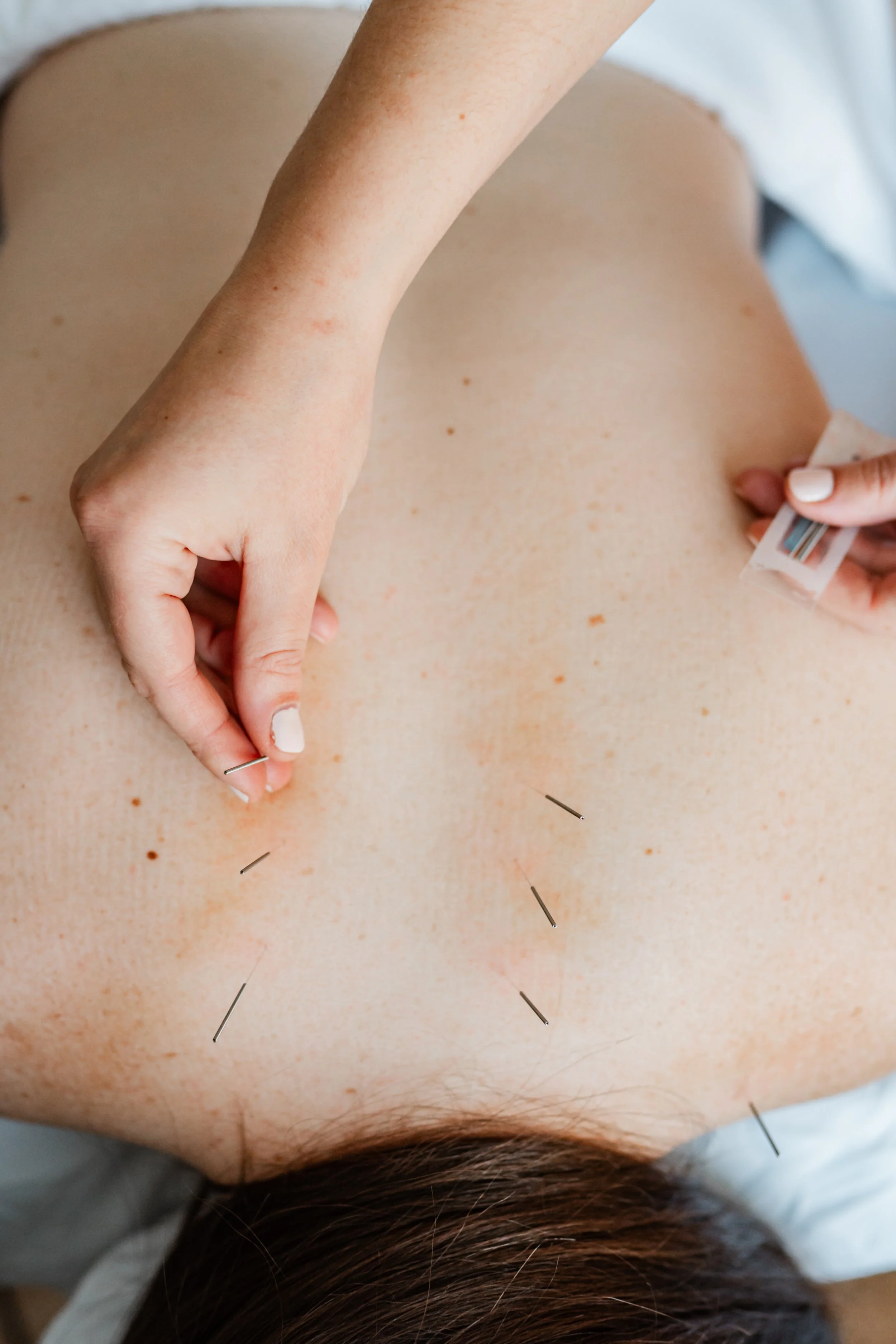 Close-up of acupuncture needles placed on skin during menopause treatment in Groton, MA