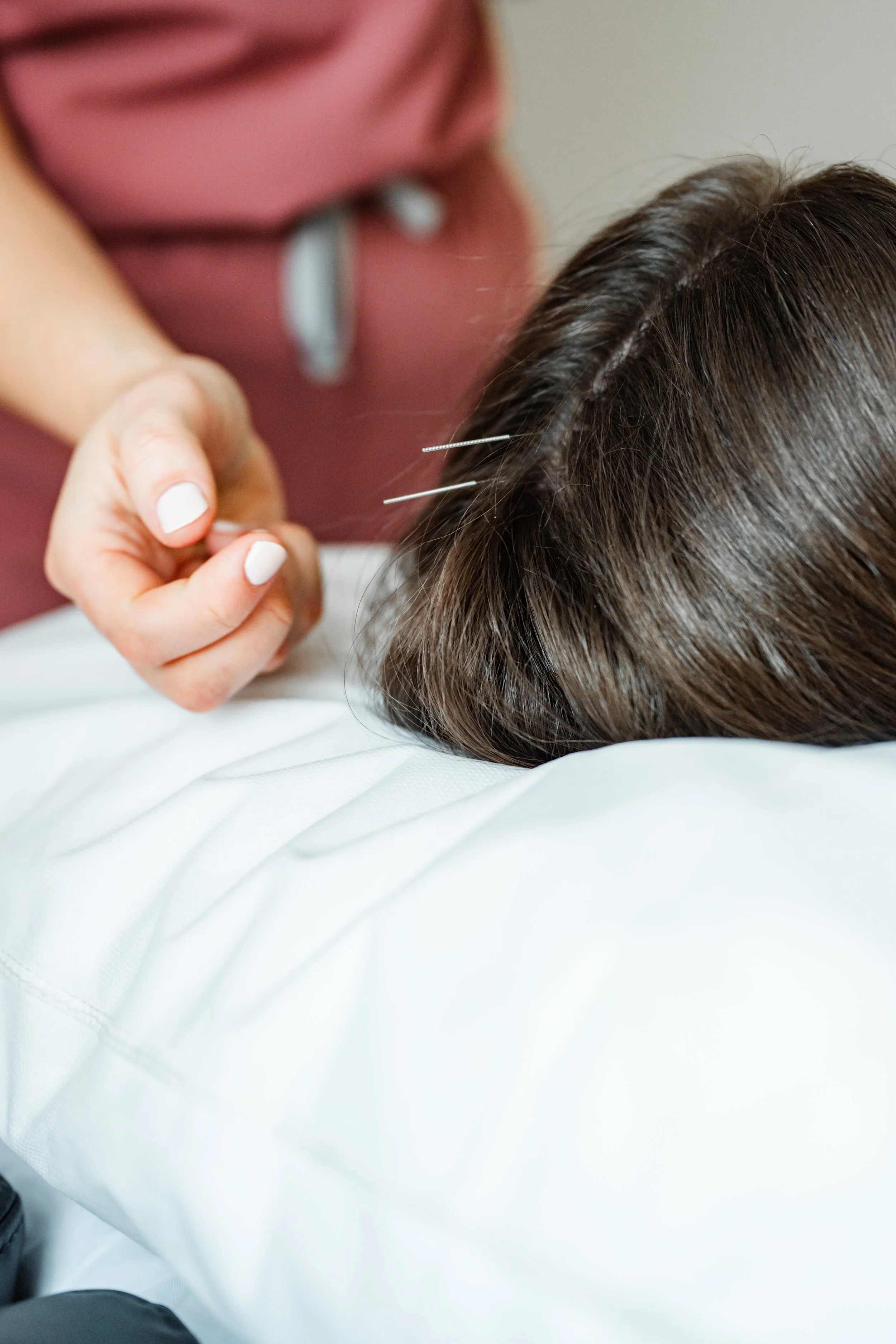 Close-up of acupuncture needles placed along a patient's scalp during a prenatal acupuncture session in Groton, MA