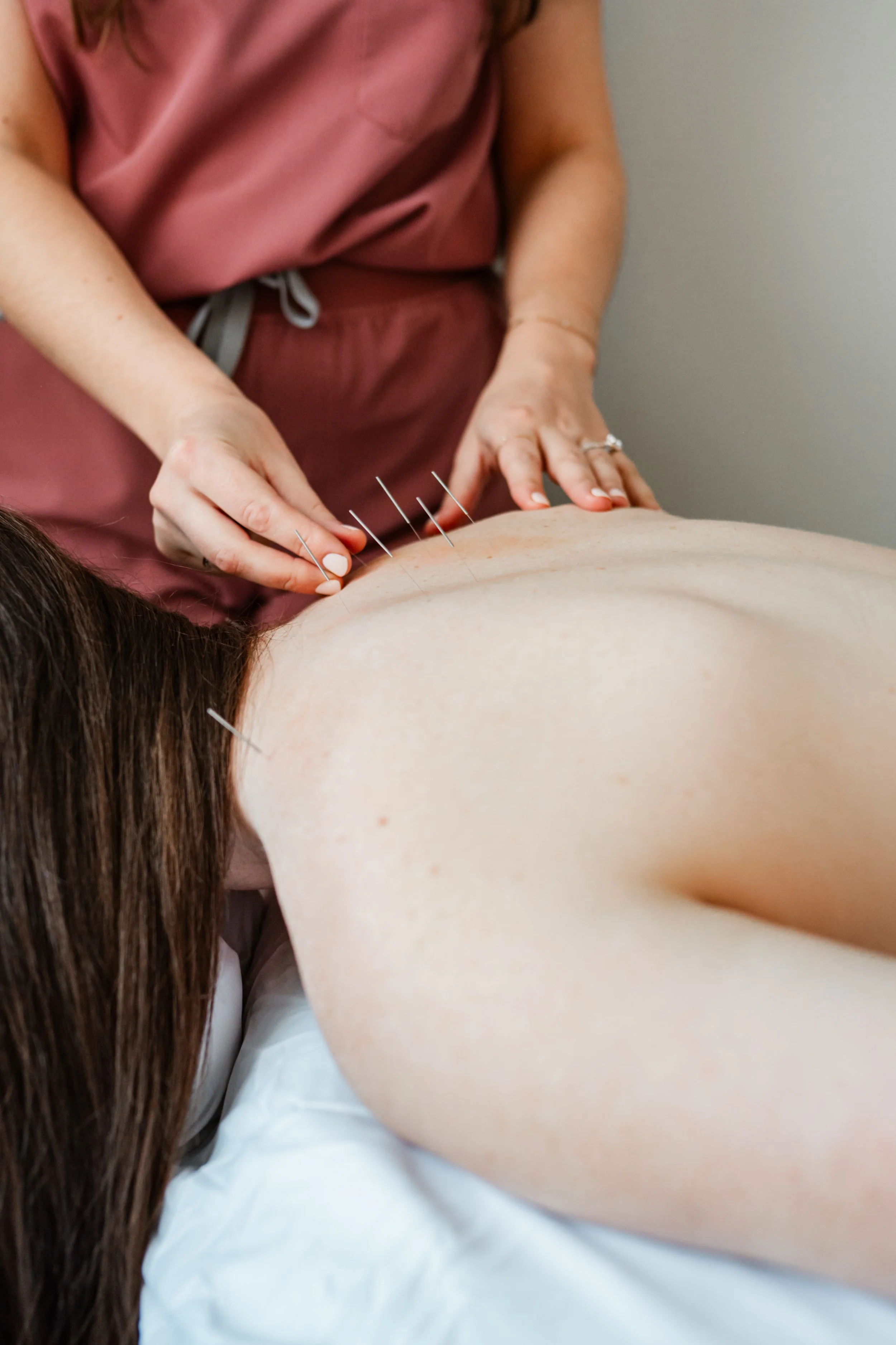 Acupuncture treatment along spine for pain relief and nervous system support in Groton, MA