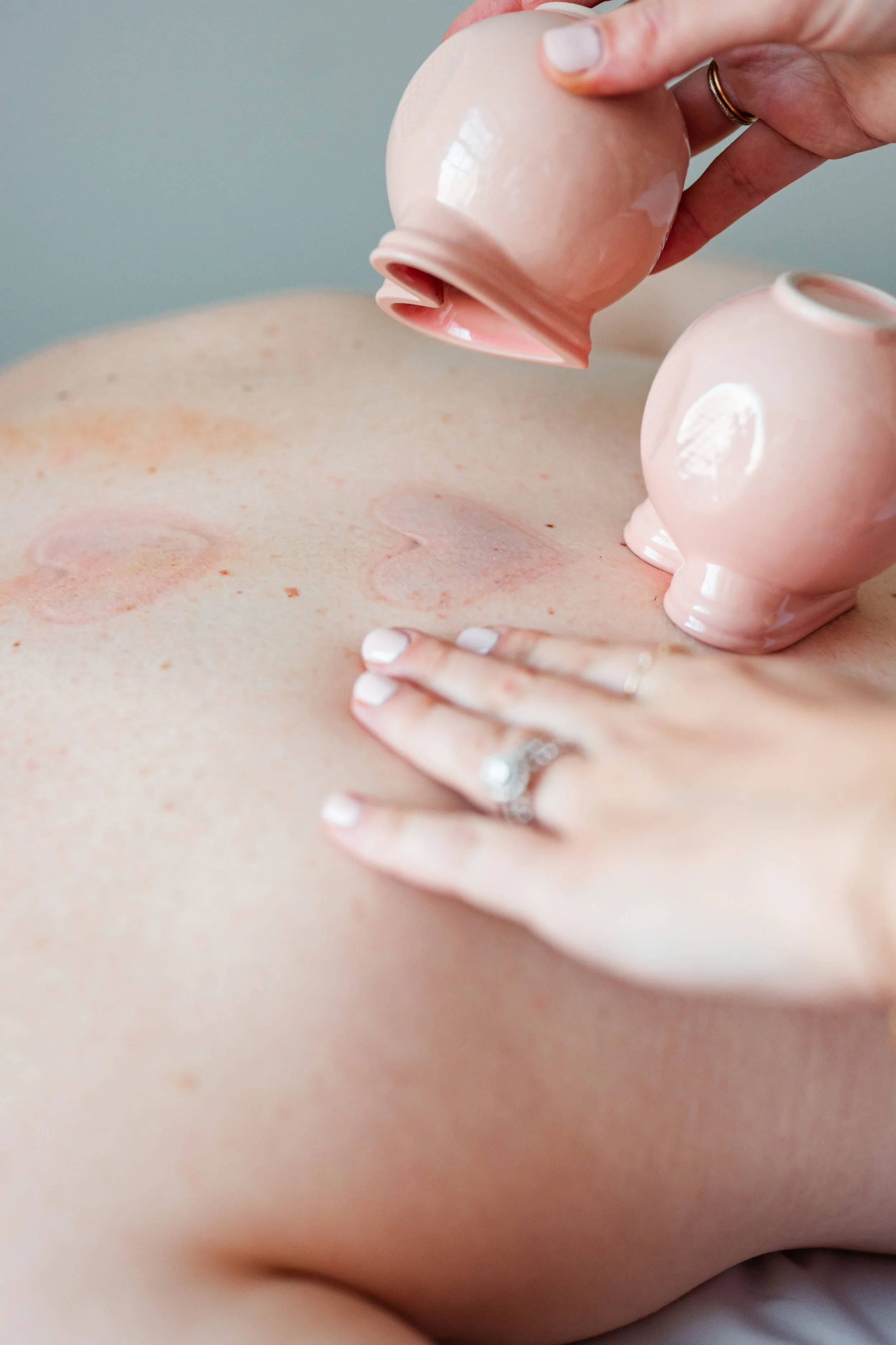 Cupping therapy applied to the back for muscle relief and pain recovery at The Violette House in Groton, MA