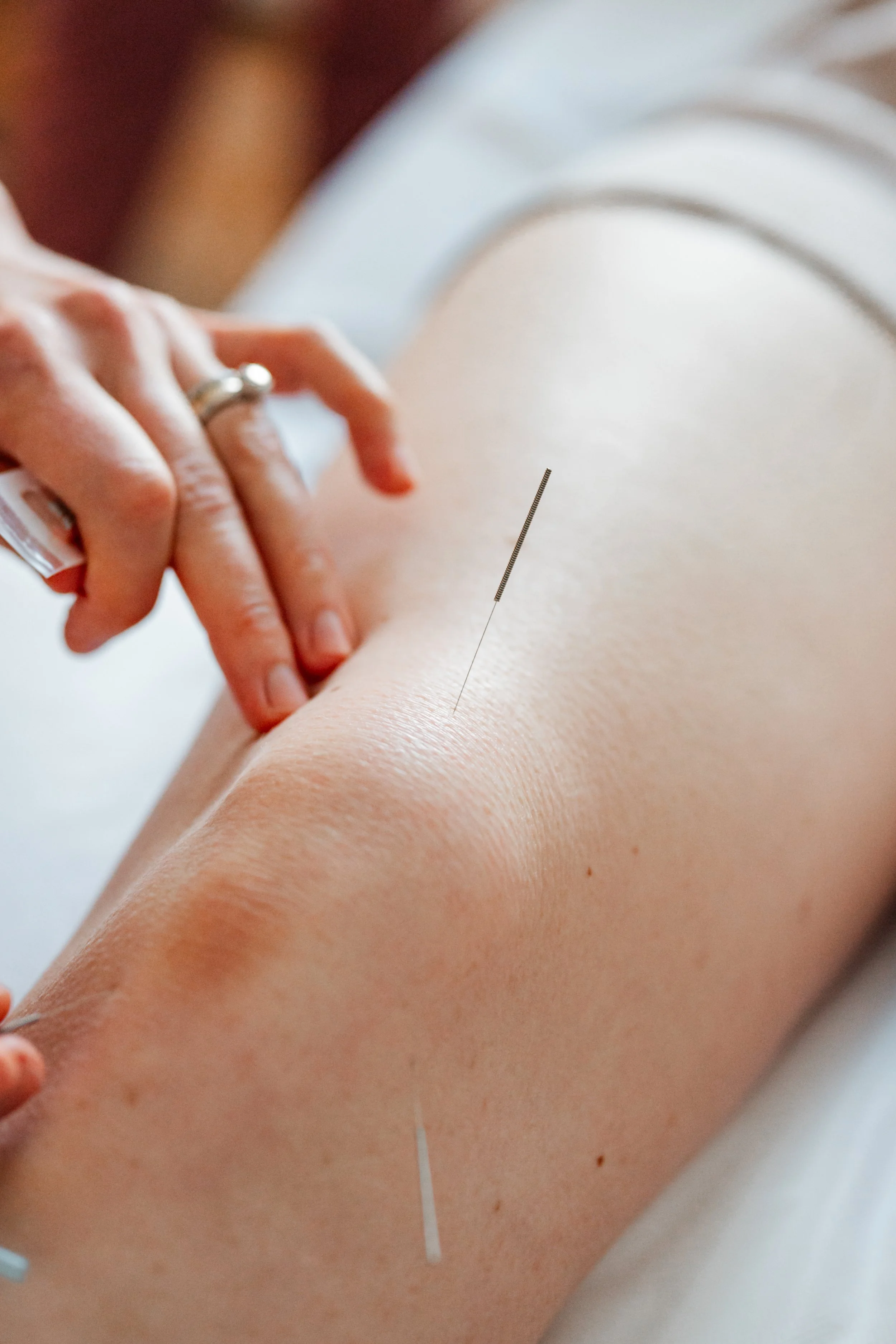 Acupuncture treatment for neuropathy at The Violette House in Groton, MA