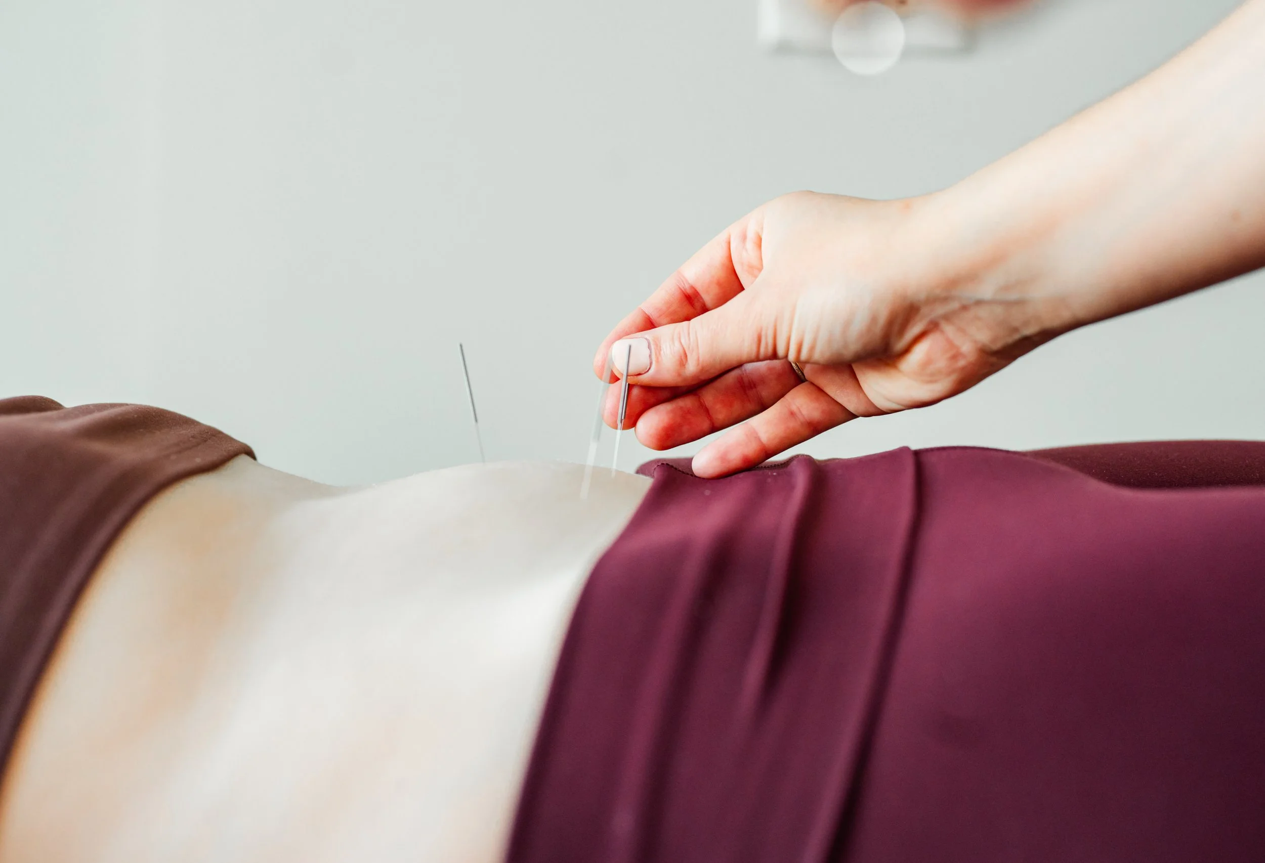 Close-up of acupuncture needles being placed on a patient's abdomen for fertility treatment
