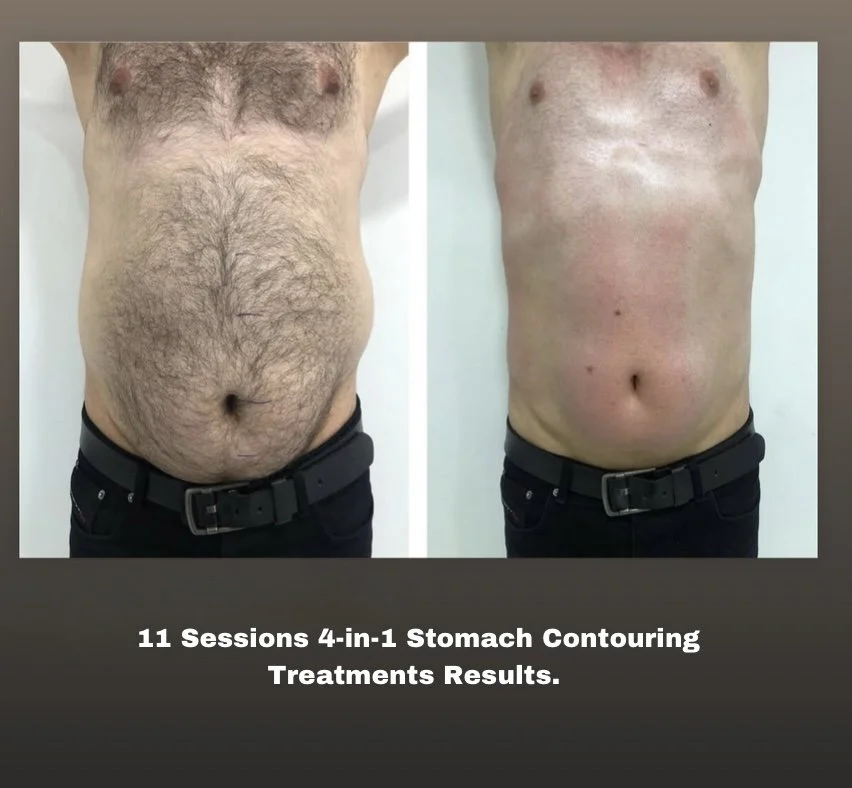 11 Sessions 4-in-1 Stomach Contouring Treatments Results..jpeg