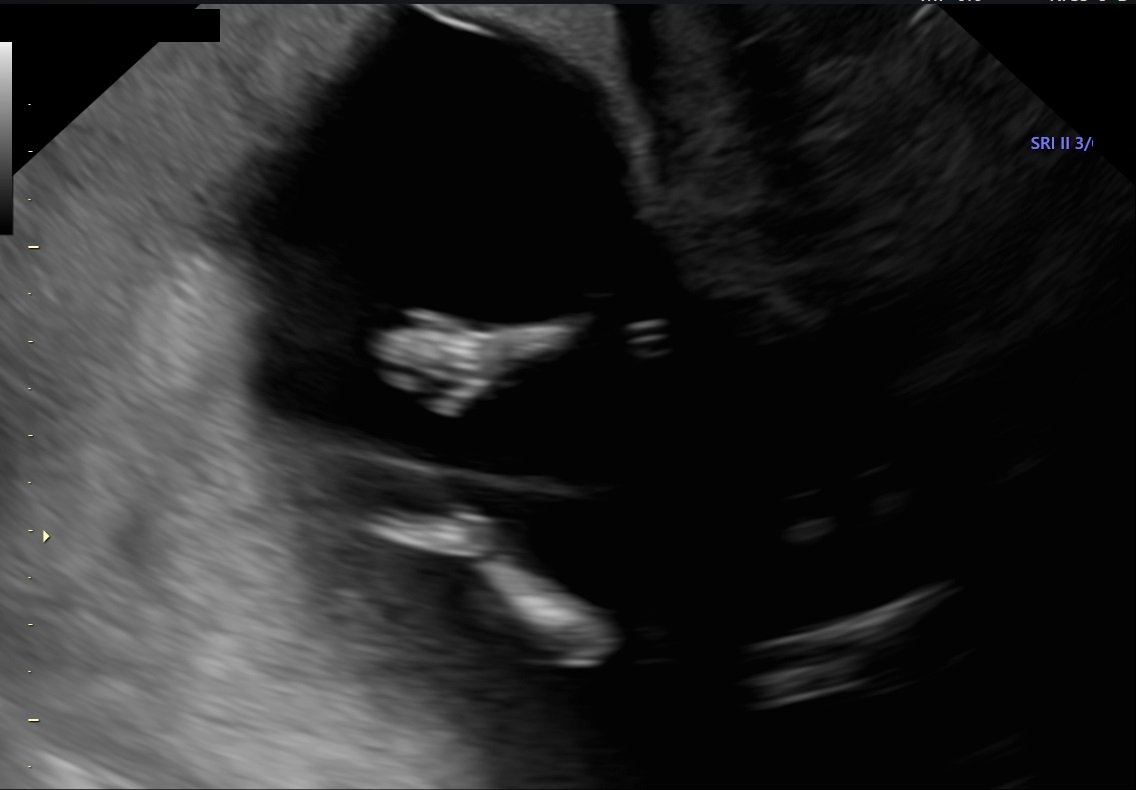 A cosmic high five. The nurse tech was looking to verify the integrity of the sac between our daughters and caught this timeless photo of them giving each other a high five.