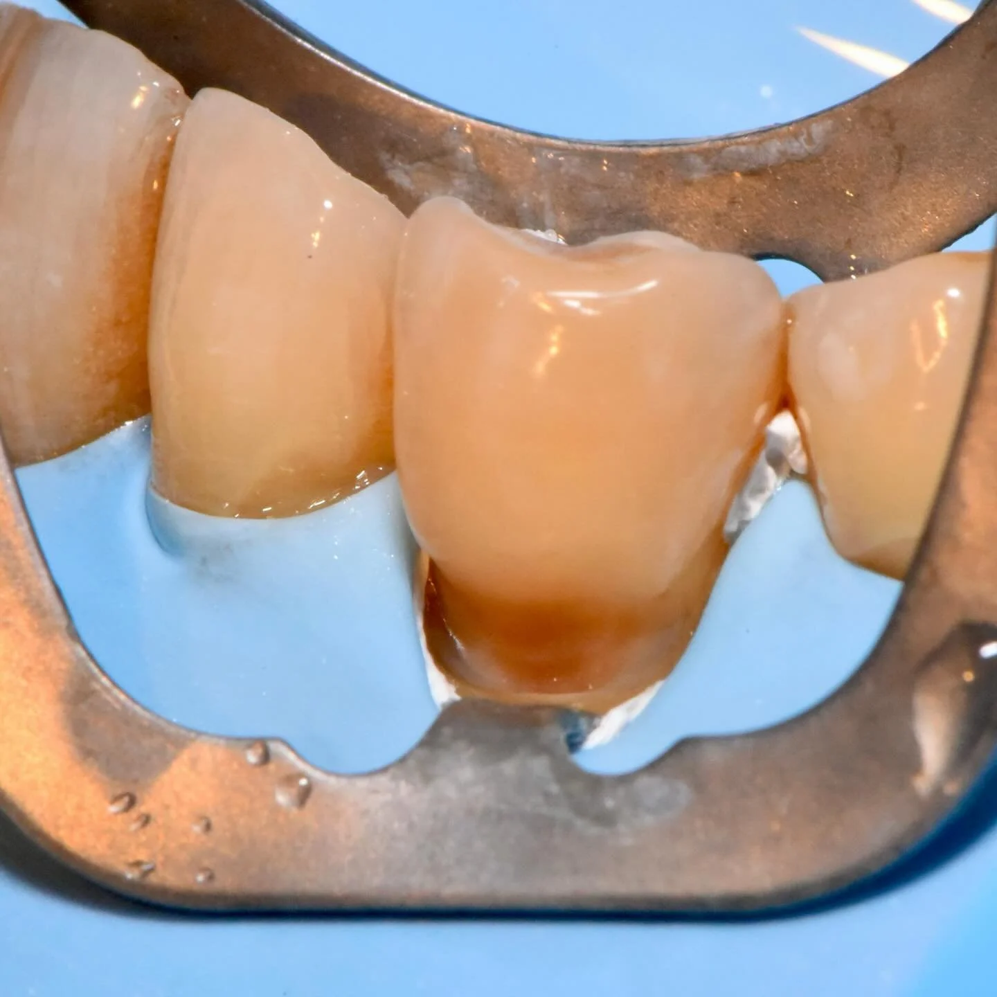 NCCL management with direct composite. Tips to make it easier and consistent :
- medium or heavy rubber dam (isodam / nictone)
- large isolation (from 16 to 11 here to work on 13 14)
- good spacing of perforations, small perforations for anterior tee