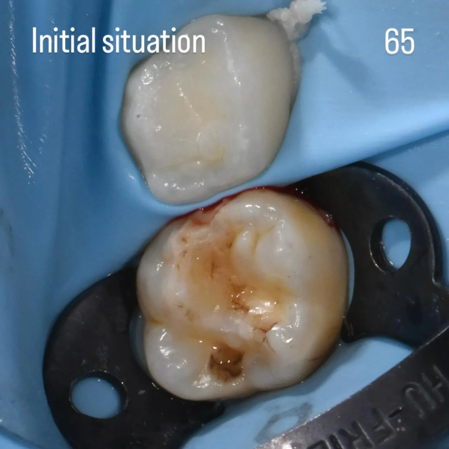 Something a bit different from the usual stuff. I saw this patient for the treatment of 55 and 65 for MIH. Silver Diamine Fluoride was ineffective in reducing the sensitivities on the two teeth, so we went for an adhesive approach. I followed the bon