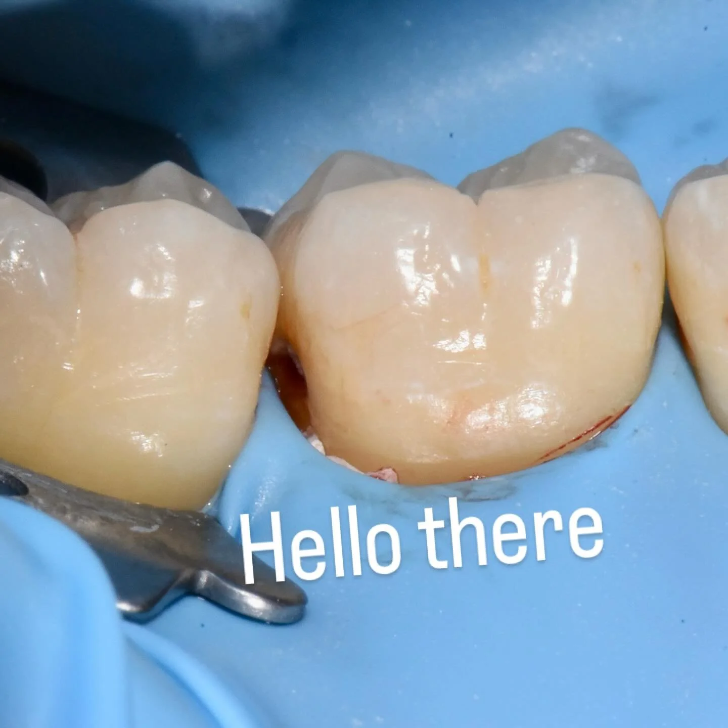 A small case of minimally invasive dentistry. A small deep distal decay was spotted by @silviaxcid and she referred the patient to see what we could do. I decided to try a buccal access. It is not always possible to do it this way, depending on the s