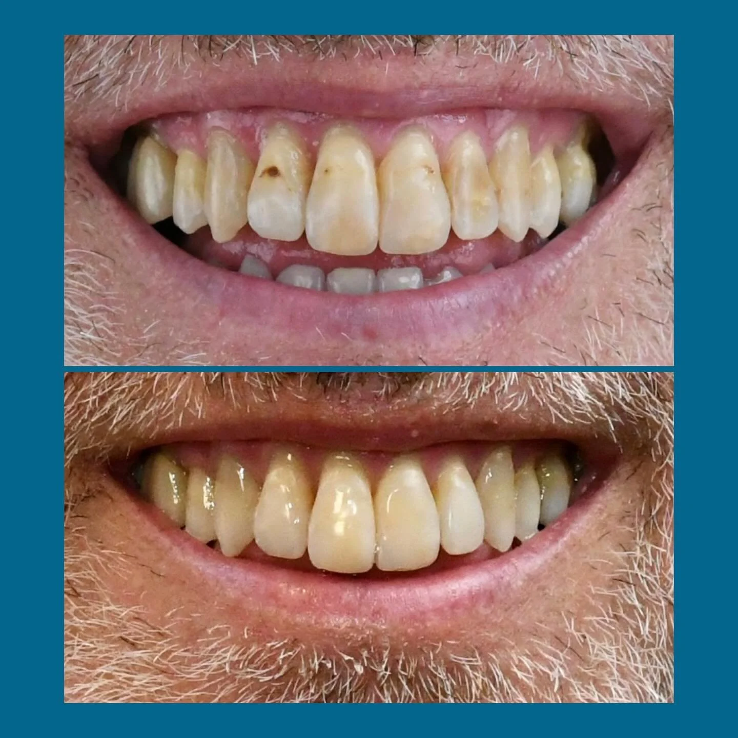 This patient was asking to see how we could improve the shade and take care of the colourations on his teeth in a minimally invasive way.

📸

Pre op pictures with blacklight transillumination and polarizing filters are a must to understand what kind