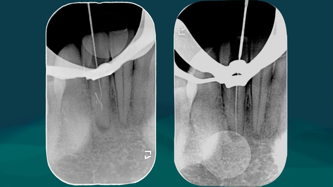 &laquo;&nbsp;How many broken files do you want ?&nbsp;&raquo; 
&laquo;&nbsp;YES&nbsp;&raquo;

🤬💀😵

A patient was reffered to us with several broken files on a lower incisor. Needless to say, it was a bit nerve wracking seeing three files inside su