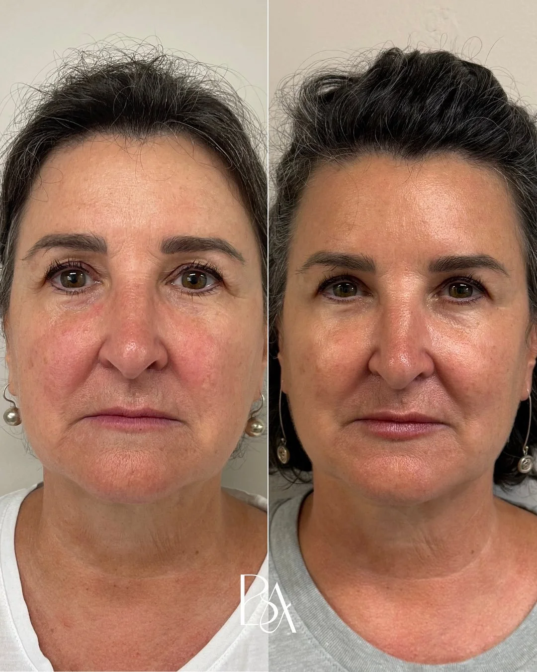 ✨ Trust the Process✨
Every face tells a story, and sometimes a little lift, smooth, and support is all it needs:

💉 Lip &amp; Midface Volume Restoration &ndash; lifts and supports the center of the face for a naturally youthful contour.

💉 Upper Fa