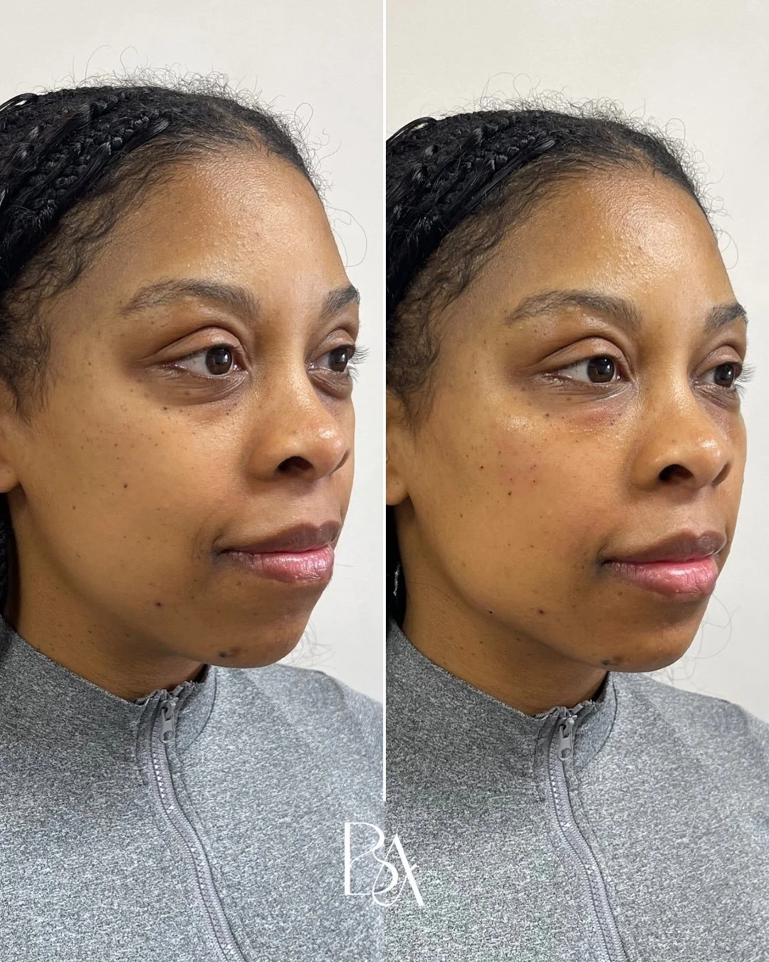 Tired eyes and a softened jawline don&rsquo;t have to stay that way. 

PRFEZ gel works beneath the skin to restore structure, hydration, and collagen support giving your undereyes a refreshed look and your jawline more definition.

📍 Annapolis, MD
?