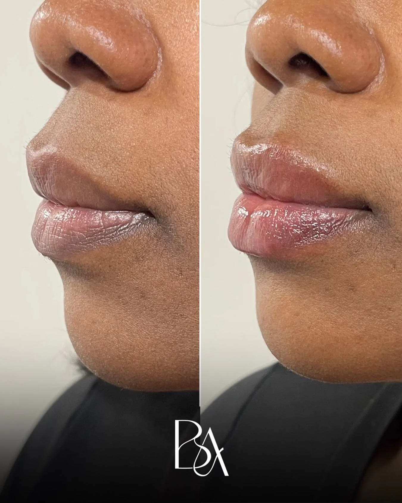 Subtle. Balanced. Beautiful. ✨
This lip filler transformation enhanced natural shape and volume while keeping everything soft and harmonious.

📍 Annapolis, MD
🔗 Link in Bio to book your consultation 

#LipFillerAnnapolis #AnnapolisMedSpa #Annapolis