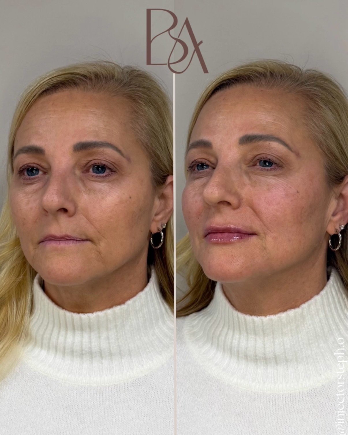 Soft doesn&rsquo;t mean overdone.
Soft means supported.

One syringe of RHA 2 placed intentionally to soften the lips, restore gentle upper-lip support, and ease laugh lines without changing who she is.

This is what refined softening looks like:
&bu