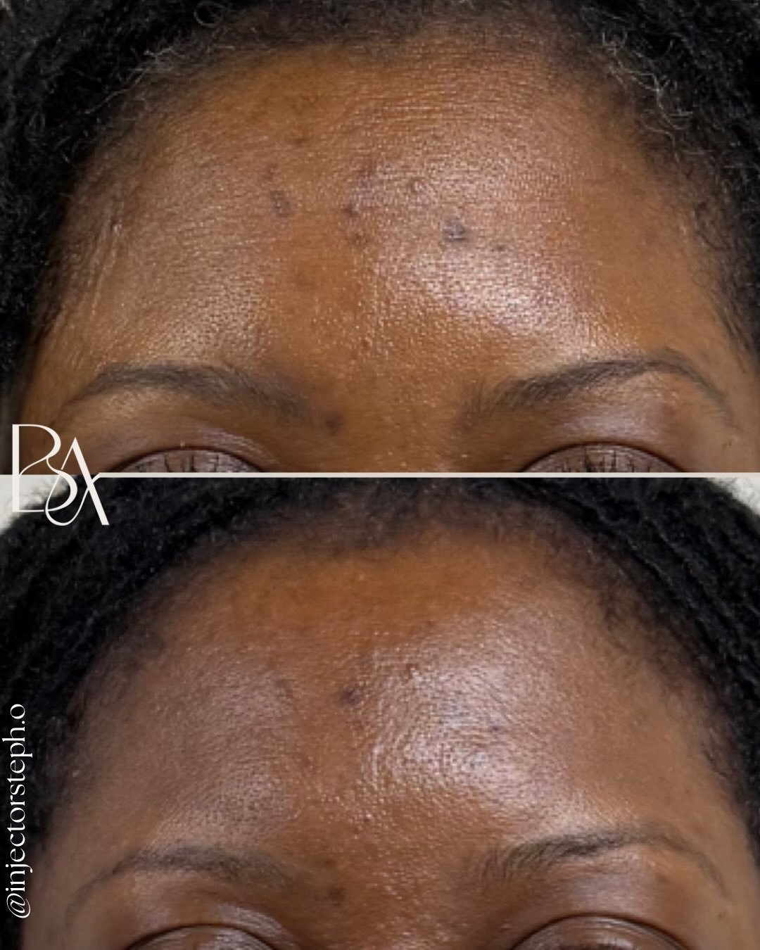 ✨ Before &amp; After | Under-Eye Brightening &amp; Skin Renewal ✨

This transformation focused on hyperpigmentation of the under eyes and surrounding area, an area that often reflects fatigue, stress, and slowed skin regeneration. With just ONE treat
