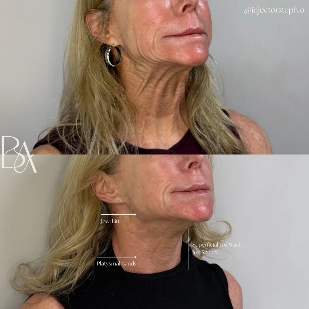 Turning back time without looking &ldquo;done&rdquo; ✨

This beautiful transformation focused on one of the most delicate (and most telling) areas of aging&hellip;the neck &amp; lower face. 
At Beige, we strategically treated platysmal bands, softene