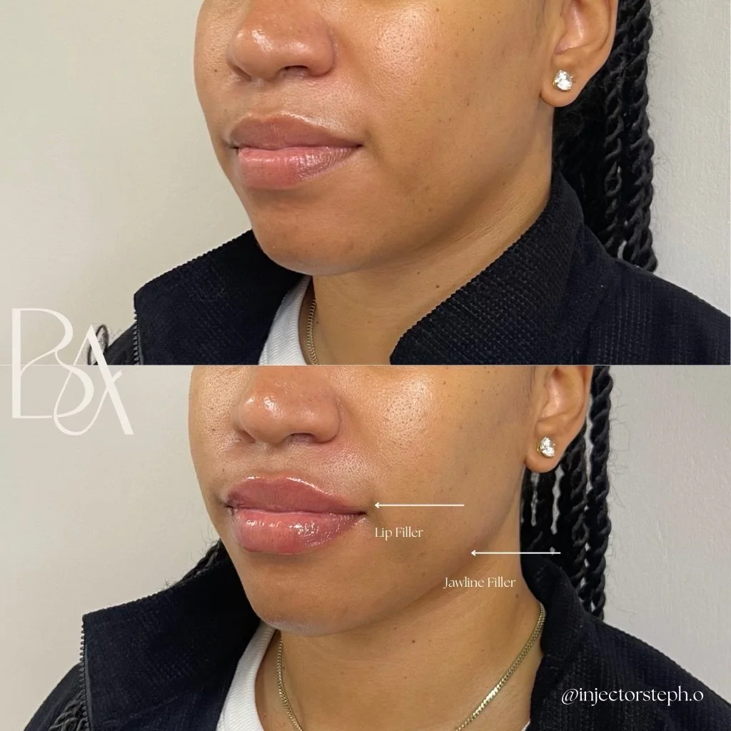 ✨ Sculpted, not overdone. ✨

Jawline and chin filler aren&rsquo;t just about adding structure they can create a subtle slimming effect by restoring balance, improving contour, and enhancing the natural angles of the lower face.

In this treatment, we
