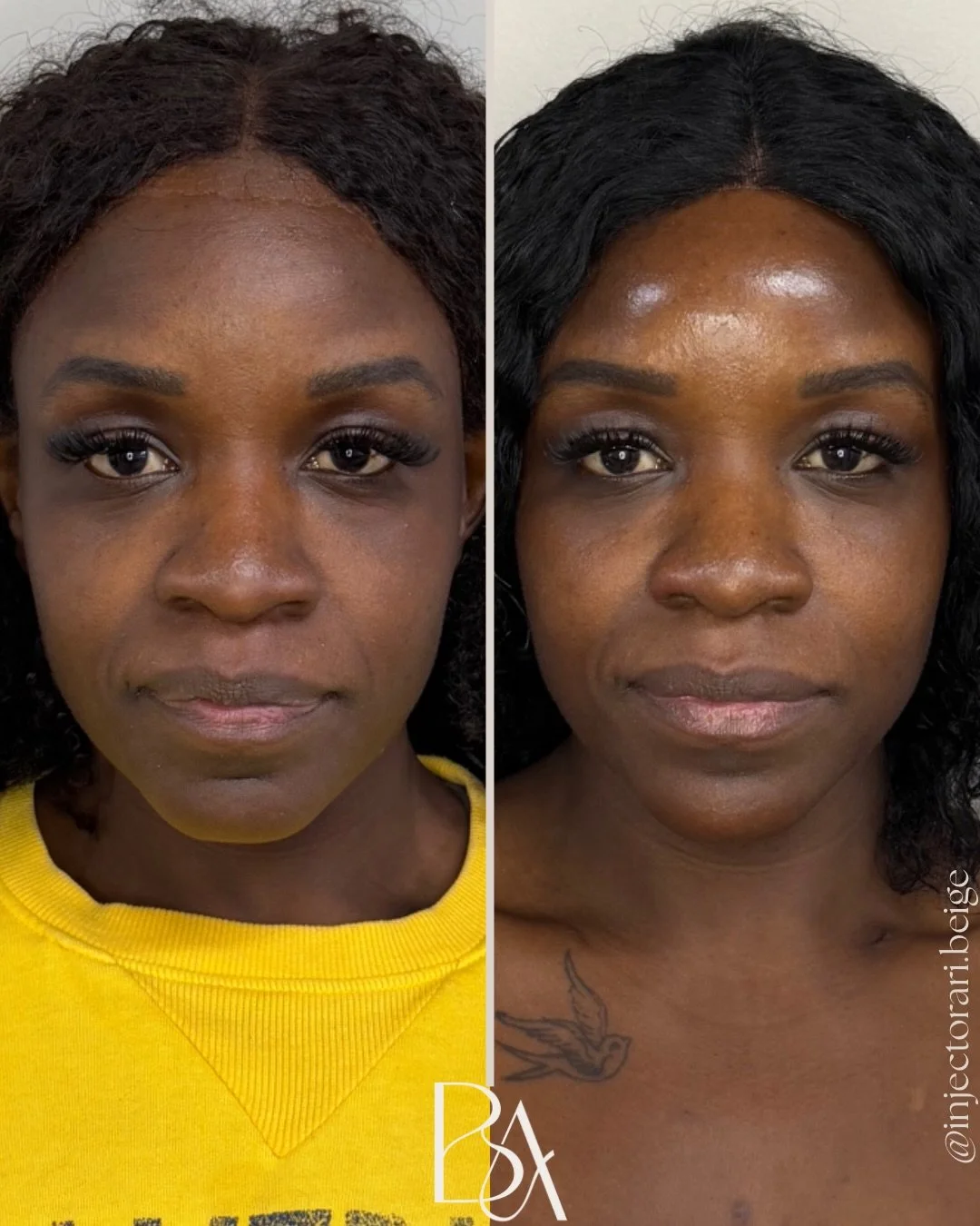 ✨Soft structure. Natural balance. Still her.✨

This transformation was all about enhancing, not changing.

With carefully placed tox, chin, jawline, and cheek filler, we refined her profile, restored balance, and kept every feature looking like herse