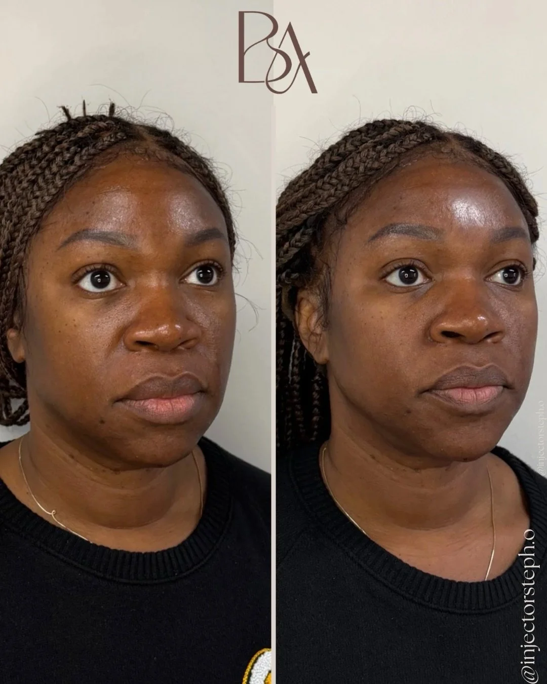 Soft. Natural. Undetectable. 🤎

At Beige Atelier, facial rejuvenation is never about changing your features &mdash; it&rsquo;s about restoring what was lost and refining what&rsquo;s already beautiful.

This transformation focused on:
&bull; Midface