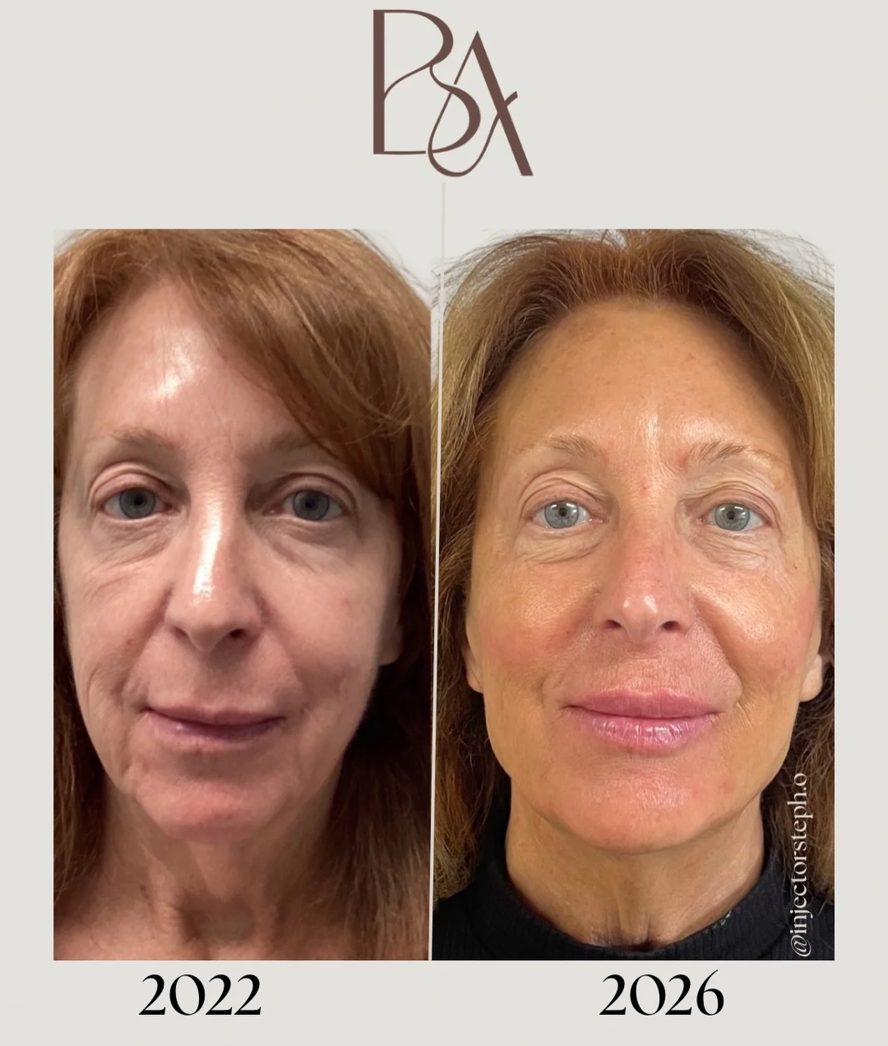 &ldquo;Aging backwards&rdquo; isn&rsquo;t luck. It&rsquo;s strategy.

2022 &rarr; 2026

This transformation was built through consistent care and thoughtful treatment planning, not a single appointment.

Over the years we&rsquo;ve focused on:
&bull; 