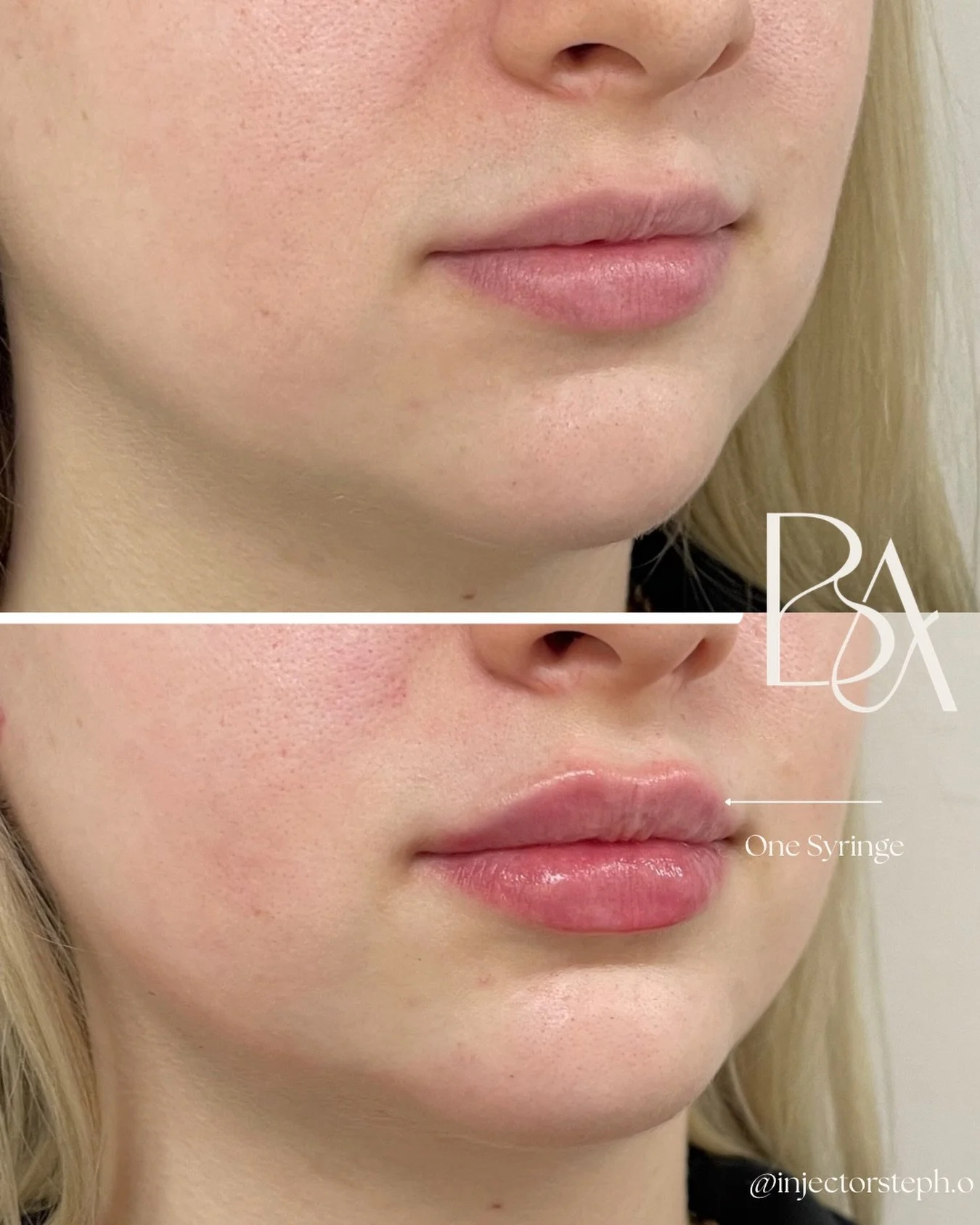 Soft, intentional, and never overdone; this is The Beige Method.

This lip enhancement wasn&rsquo;t about making them &ldquo;bigger.&rdquo; It was about refining structure, enhancing natural shape, and restoring balance to what was already there. Eve