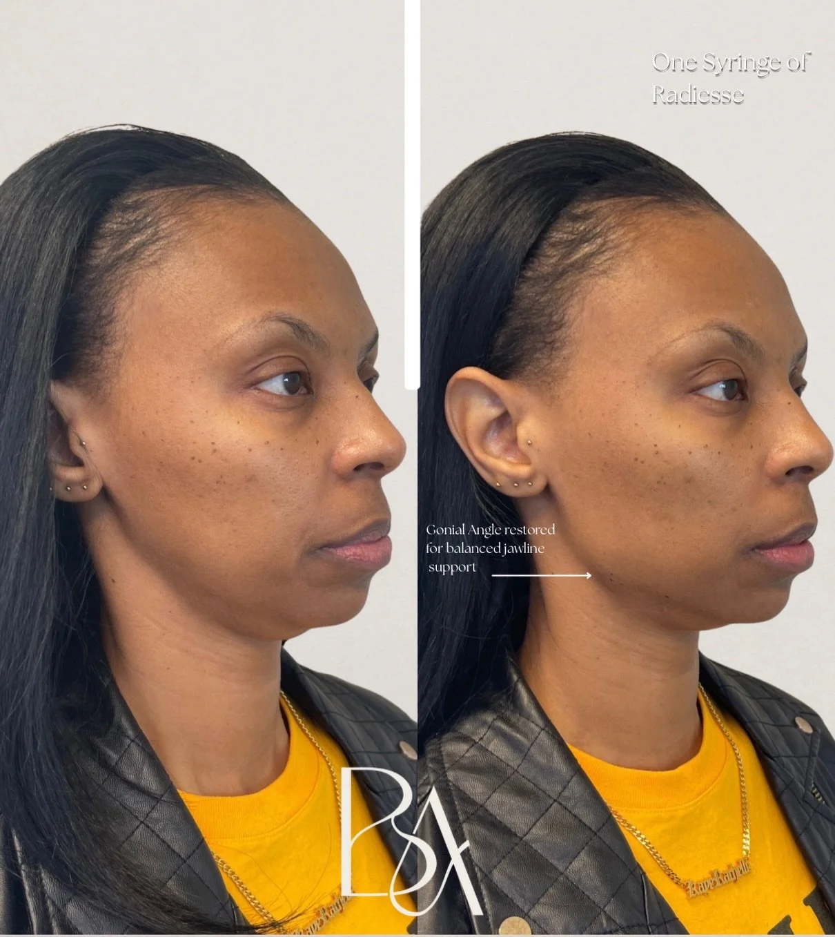 Not everything needs volume.

Sometimes the goal is simply&hellip; support and definition!

This result was created using a collagen stimulator (Radiesse) to reinforce the lower face addressing early softening along the mandibular border without alte