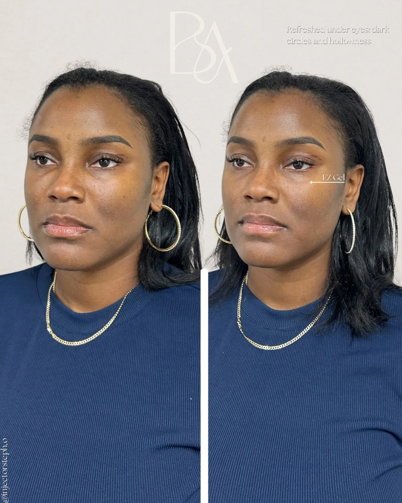 Refinement, not replacement.

This under-eye transformation was achieved using EZ Gel, restoring volume, softening hollowness, and improving the appearance of dark circles while preserving the integrity of her natural features.

What makes this resul