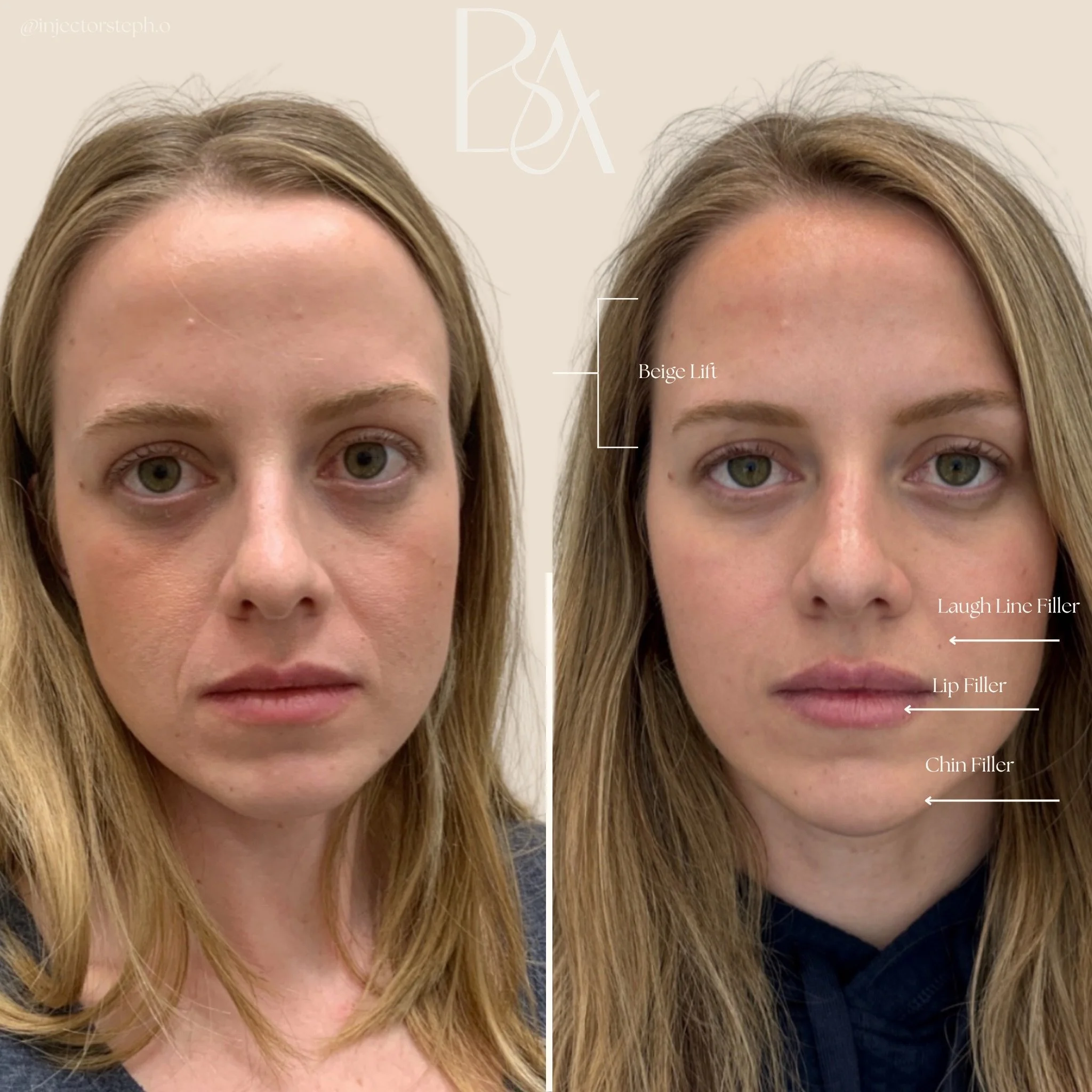 Good results can happen in one session.
Great results are built over time.

This client&rsquo;s outcome was achieved through:
The Beige Restore + The Beige Lift
with a finishing touch of The Beige Lip

Instead of chasing quick fixes, we focused on:
&