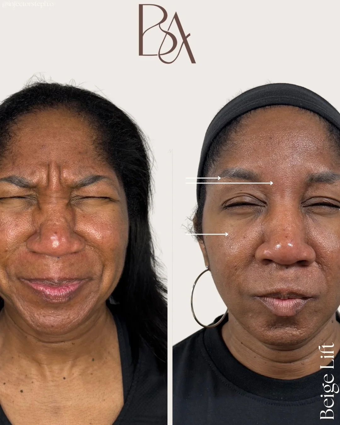 Beige Lift, refined. Not rewritten. 

A subtle lift, but everything feels more refreshed. 
For this transformation, we approached her face through The Beige Method focusing on support, balance, and natural rejuvenation rather than drastic change. Usi