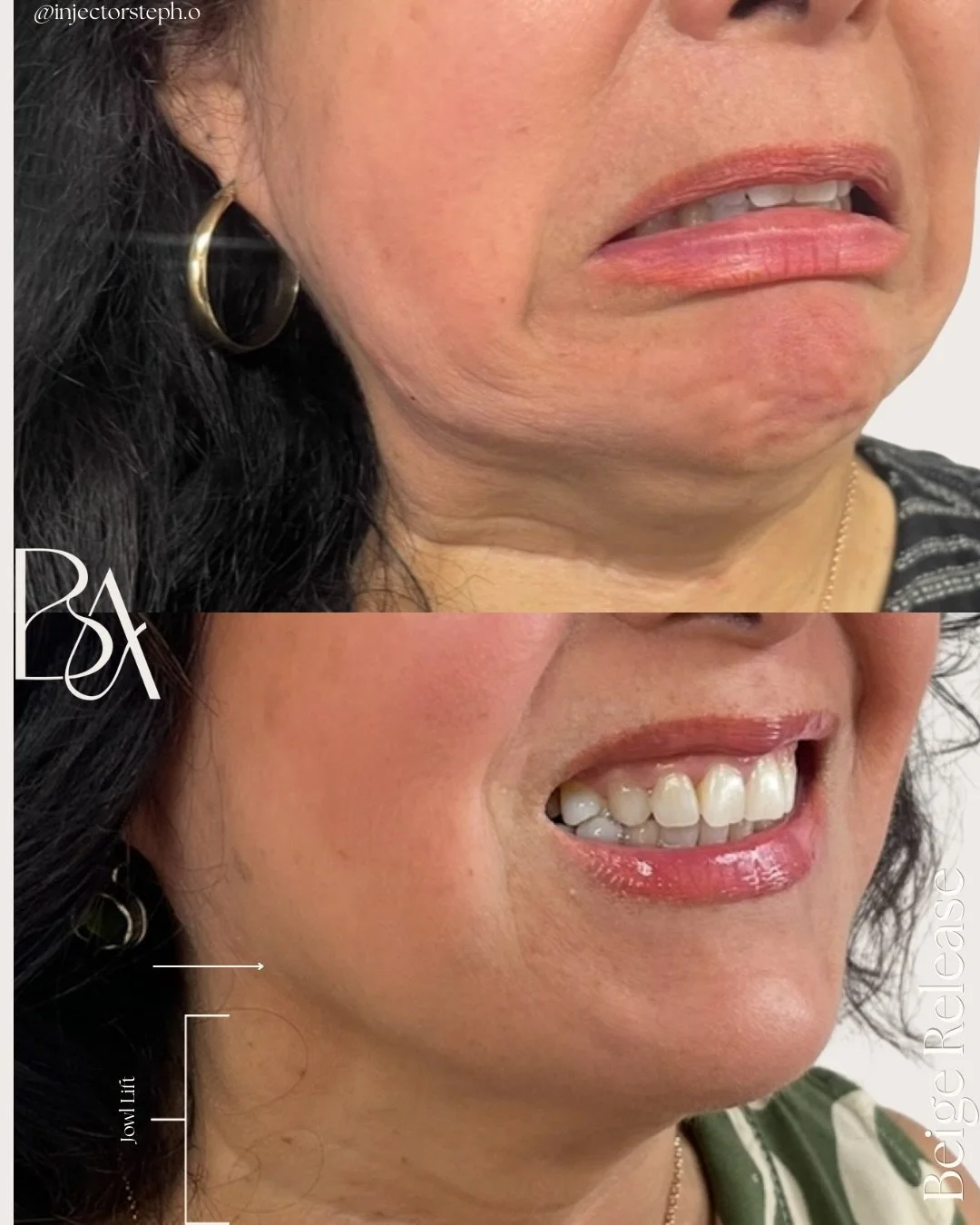 Not all tox is about lifting.
Sometimes, the transformation comes from knowing what to release.

The Beige Release technique focuses on softening the downward pull that can contribute to heaviness through the lower face + jawline. By strategically tr