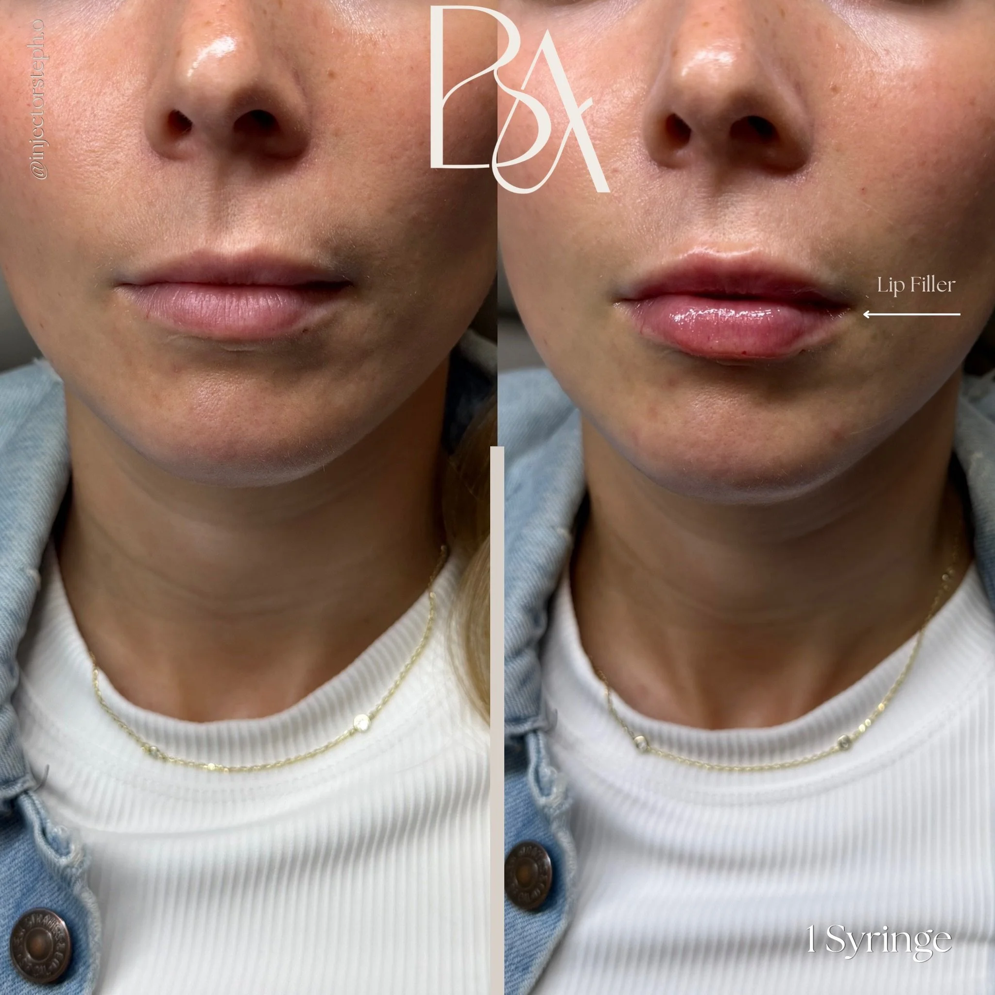 The Beige Method: lips that fit you. 🤍

For this transformation, we used just 1 syringe of filler to create balance, hydration, and soft structure &mdash; never overfilled, never distracting. The goal wasn&rsquo;t bigger lips. It was restoring harmo