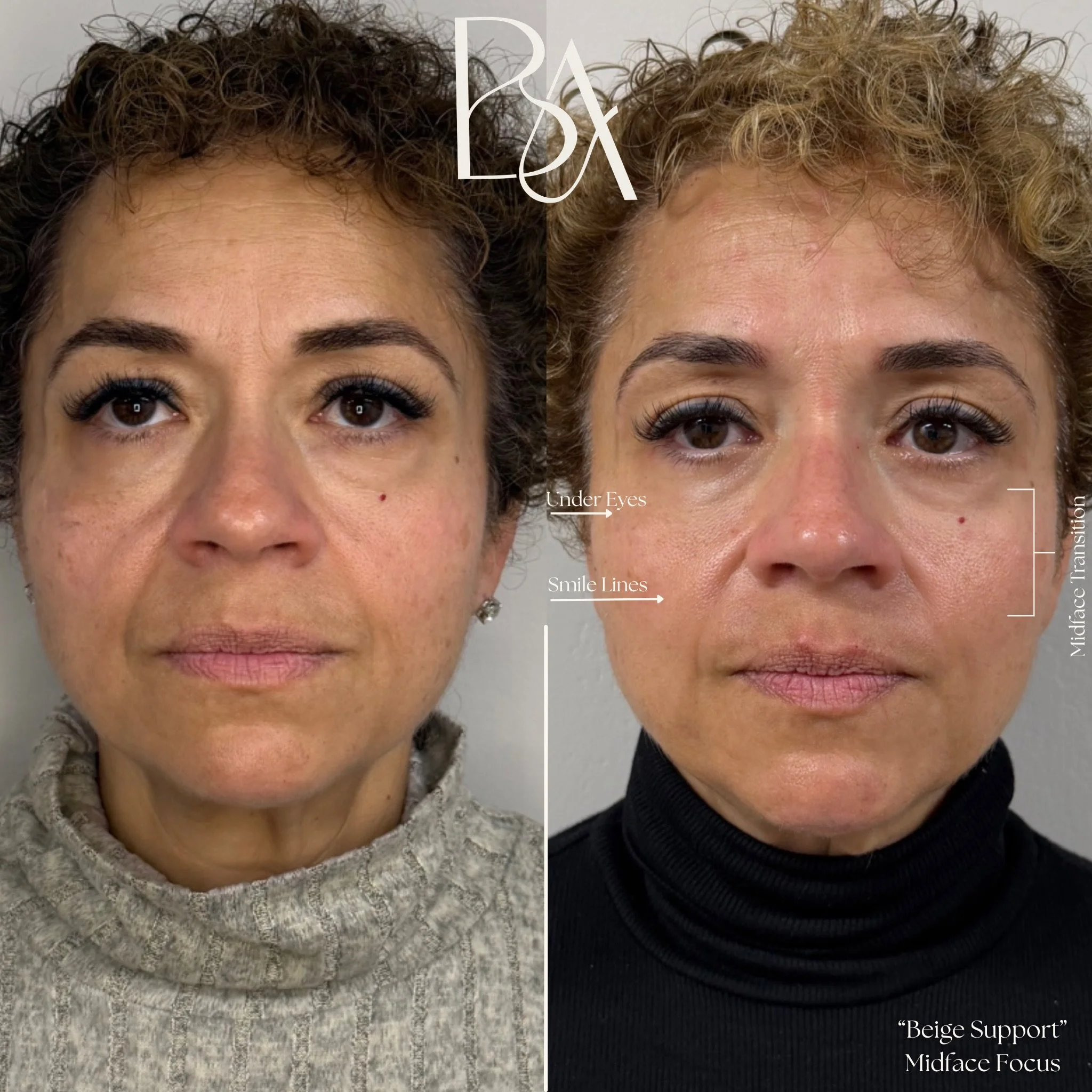Soft support. Subtle lift. Timeless results. ✨

For this treatment, we focused on the midface using HA dermal filler to restore structure and soften the under eye to midface transition. By strategically supporting the cheeks, we were also able to sof