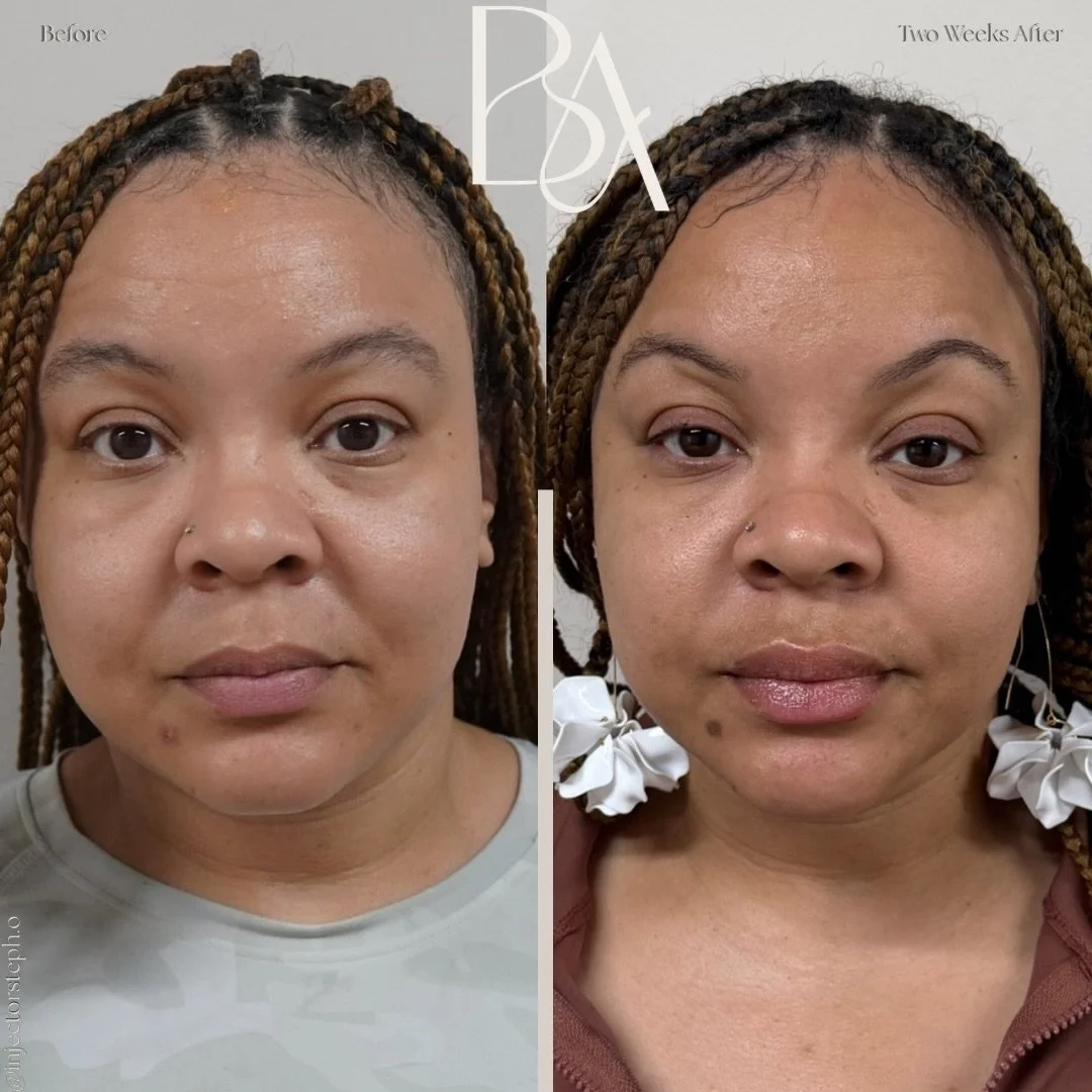 Two weeks makes all the difference. ✨

This before-and-after showcases our patient&rsquo;s results two weeks following lip filler treatment. As the filler settles and integrates with the tissue, swelling subsides and the final result begins to reveal