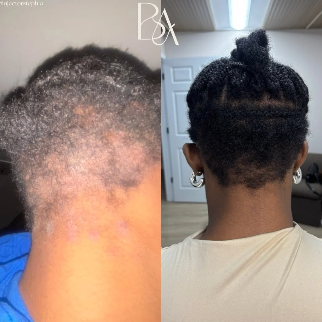 What if your scalp could finally breathe again?

This is Week 7 of Week 10 our Beige Hair Growth Protocol, and the results speak for themselves. ✨

Our client has been coming in weekly for targeted microneedling along the hairline and areas affected 