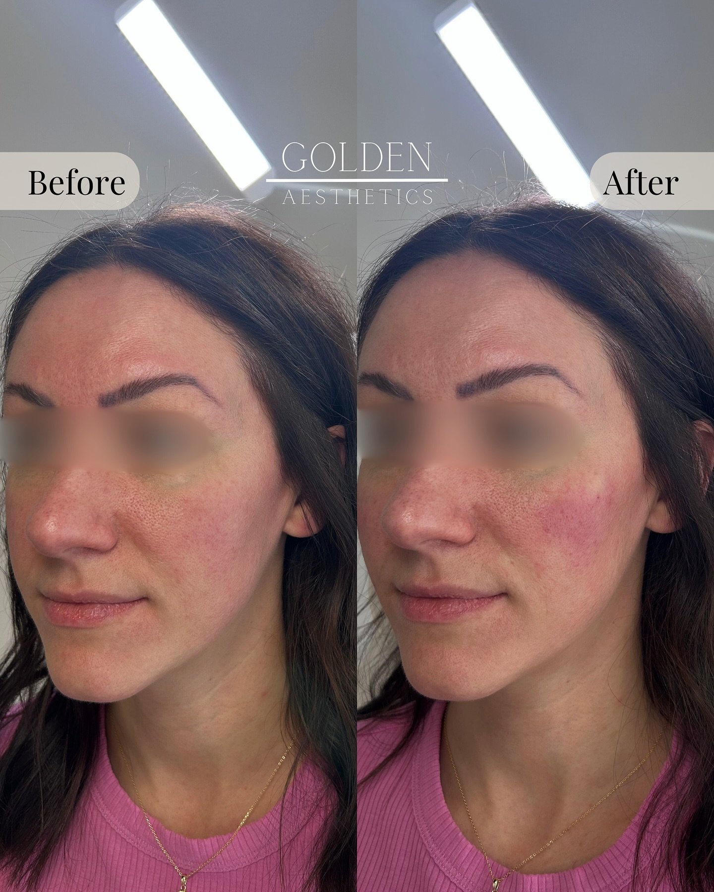 Ok queen, pop off!

Part of my facial balancing strategy (custom to each client) for this gorg gal included lifting her cheeks for that contoured, sculpted look. Just look at how refreshed she is 🤌

Cheek filler is subtle but so effective. Want some
