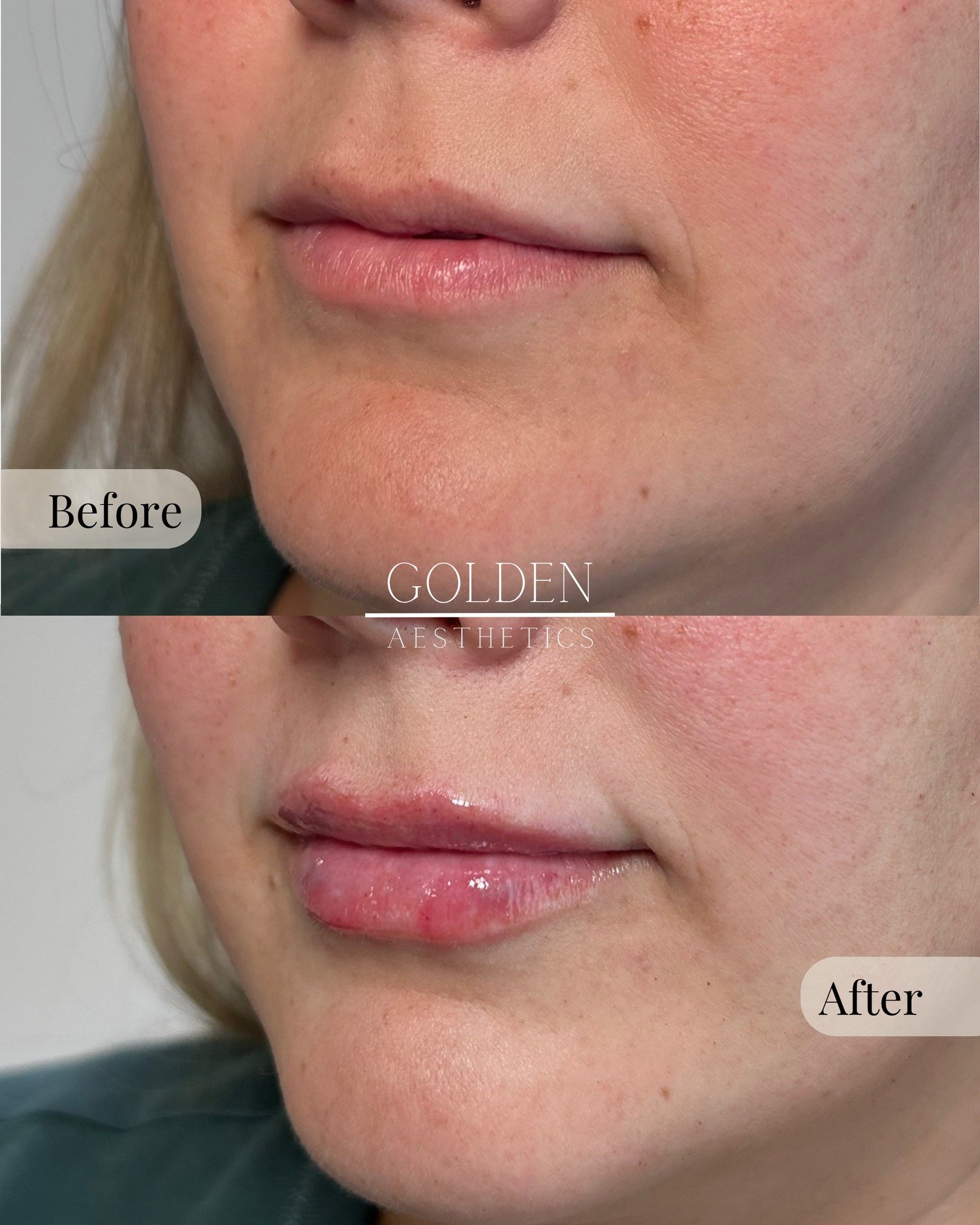 M-shaped lip correction = balance, symmetry, and soft definition right where it counts.

This treatment enhances the Cupid&rsquo;s bow and restores volume across the top and bottom for lips that look naturally full 💋

Our clients love the flirty lif