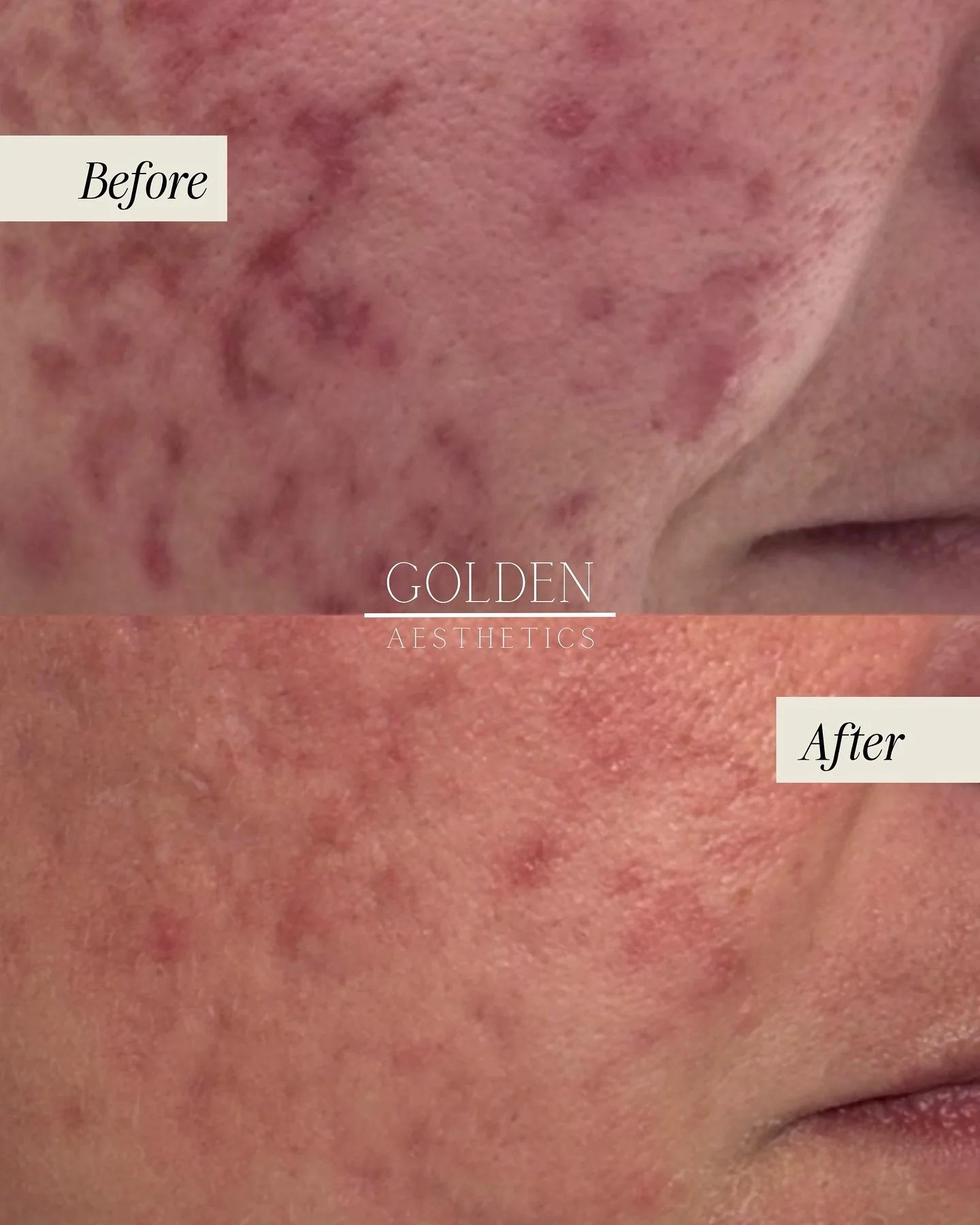 I don&rsquo;t mean to be dramatic but when I was looking at this before &amp; after I almost teared up 🥹✨ it is SO cool to be part of someone&rsquo;s skin journey.

This transformation came from only TWO SESSIONS of microneedling, one of my fave tre