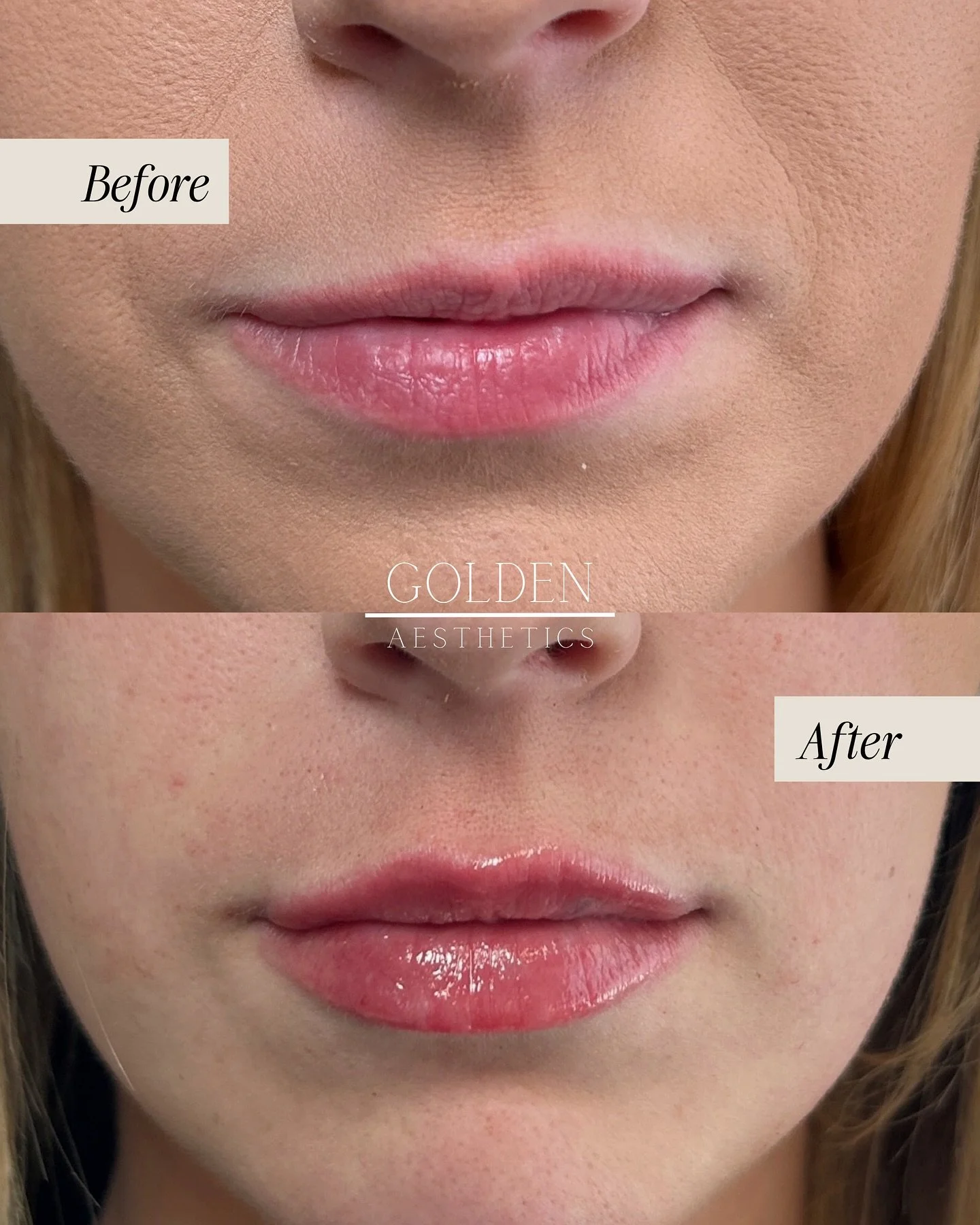 Okay💉!! This client wanted symmetry correction with balance and hydration without overhauling her natural lip shape.

I focused on adjusting the mild asymmetries, redefining the border for a more structured outline, while providing subtle volume and