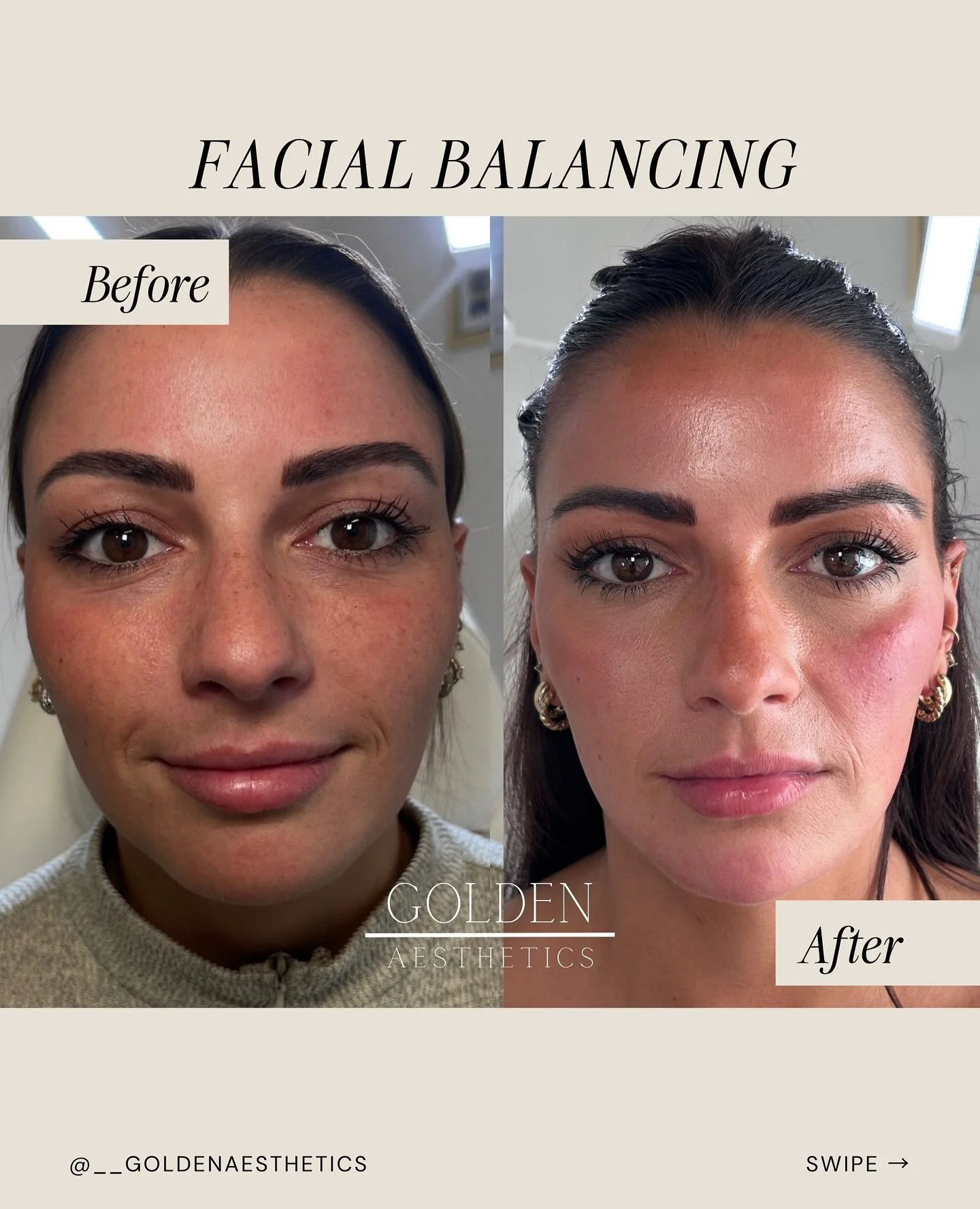 Facial balancing is one of my favorite treatments to perform because I get to be both strategic and creative.

In this angel&rsquo;s case, we focused on enhancing structure and balance with:

💉 Cheek filler to lift and contour
💉 Chin filler for pro