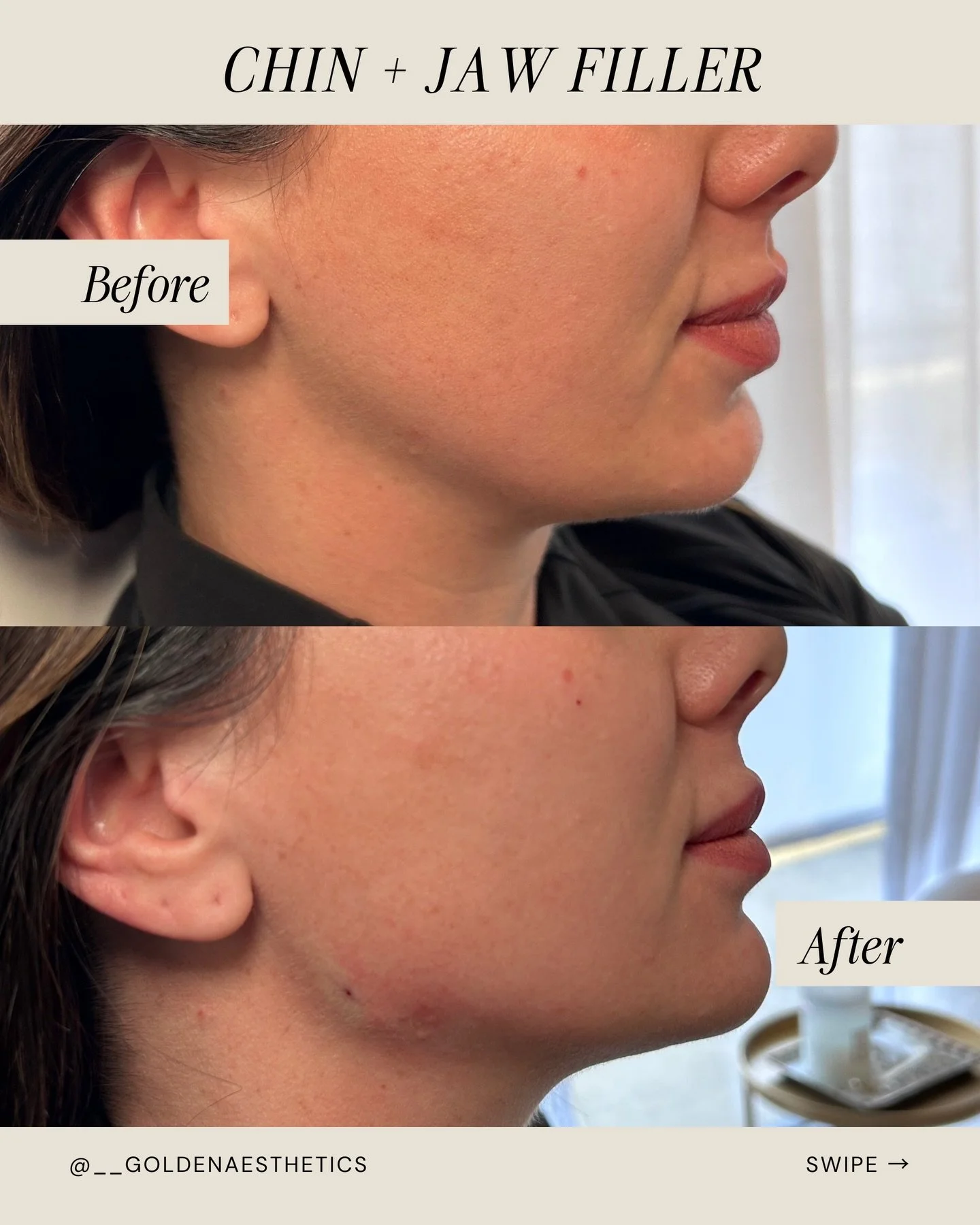 Never underestimate what a little jaw definition can do 👏

Balancing the jawline and chin can completely change facial harmony, contouring, and lifting all at once!

I loved working on this beauty! Curious what filler can do for you? Book your servi
