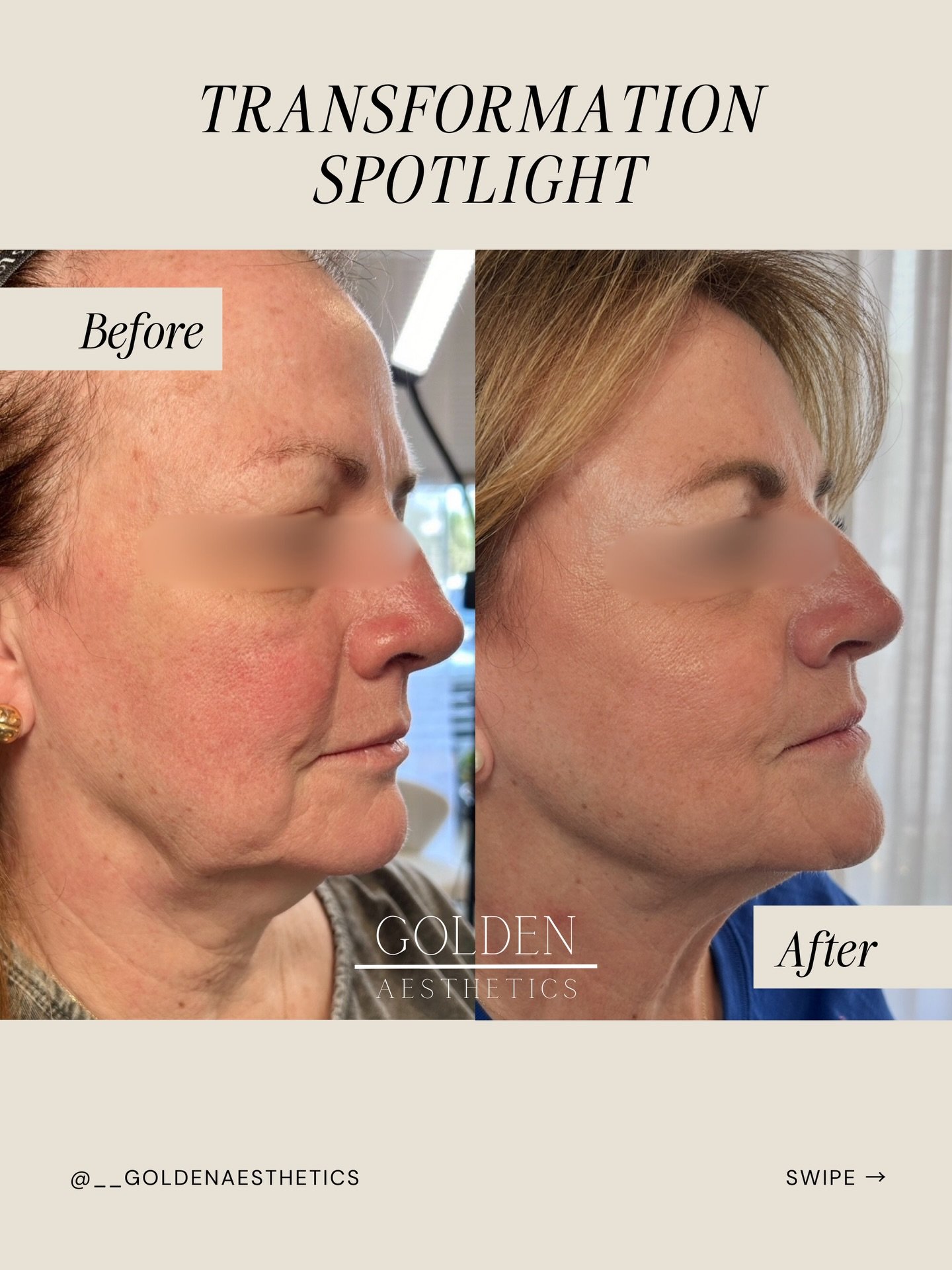 Excellent results don&rsquo;t happen overnight. They take time and a combination of different modalities.

We&rsquo;ve been working with this client to help restore her confidence, and dare I say she is 👏rejuvenated👏

Her customized treatment plan 