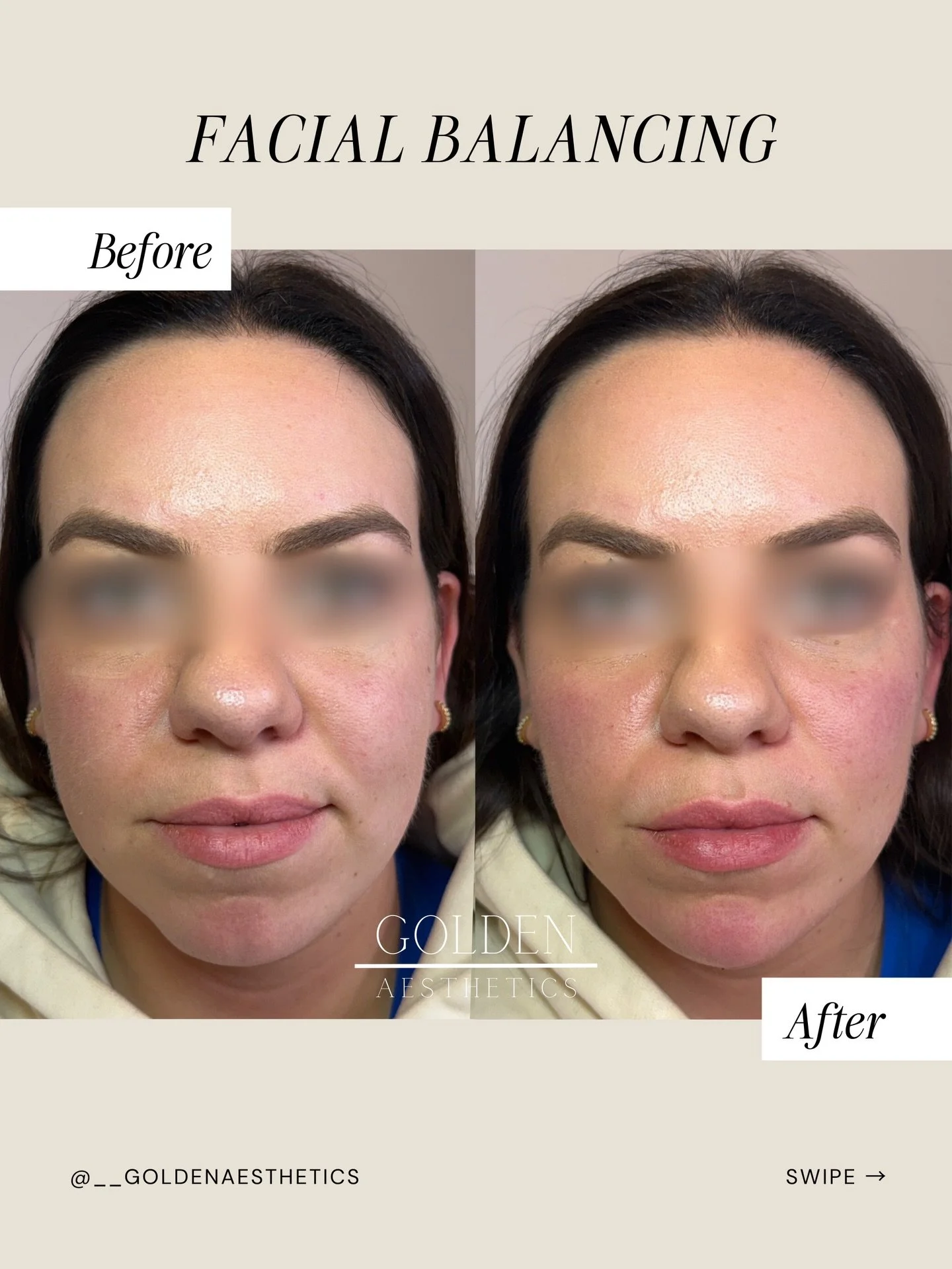 Hot take that shouldn&rsquo;t be a hot take: More syringes do not equal better results.

What actually enhances your already gorgeous face is understanding anatomy and proportion.

For this angel client, that meant strategic midface support, chin ref