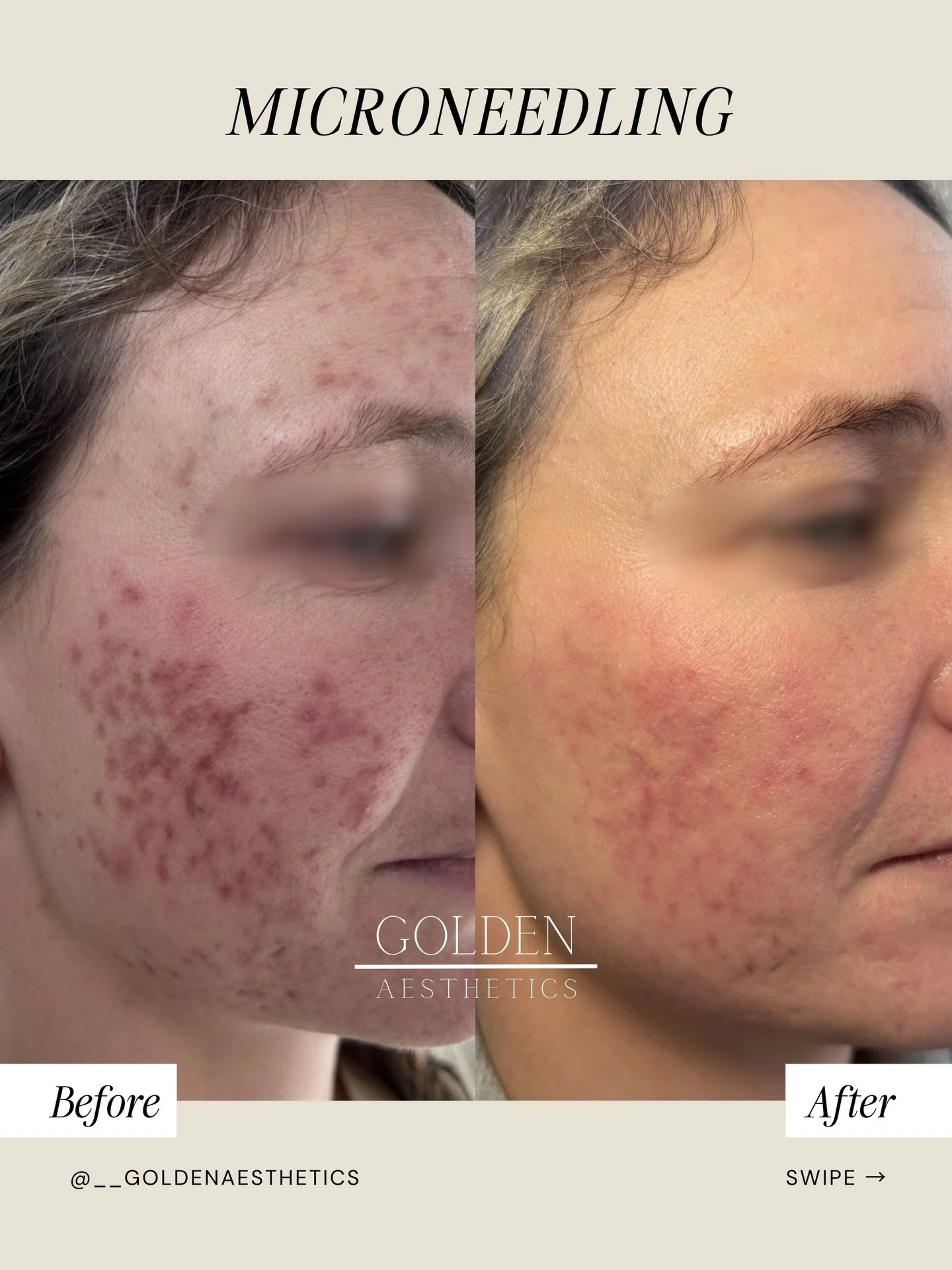 This is your reminder that acne scars can be treated 🤍

Acne scars form when severe inflammation damages the skin structure. Microneedling creates controlled micro-injuries that stimulate the production of new collagen and elastin. As the skin repai