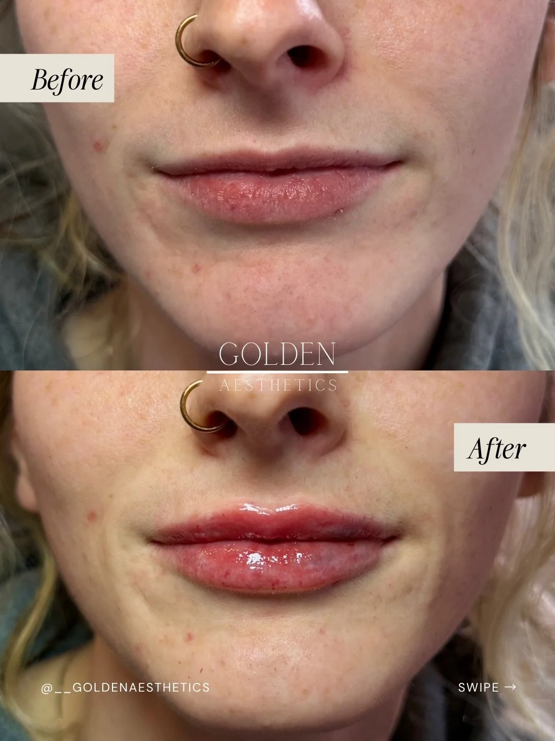 Worried about looking overfilled? Read this first:

Good lip filler is customized to your anatomy and goals. For some patients, that means soft hydration and a little more definition. For others, it means building a fuller look over time.

The key is
