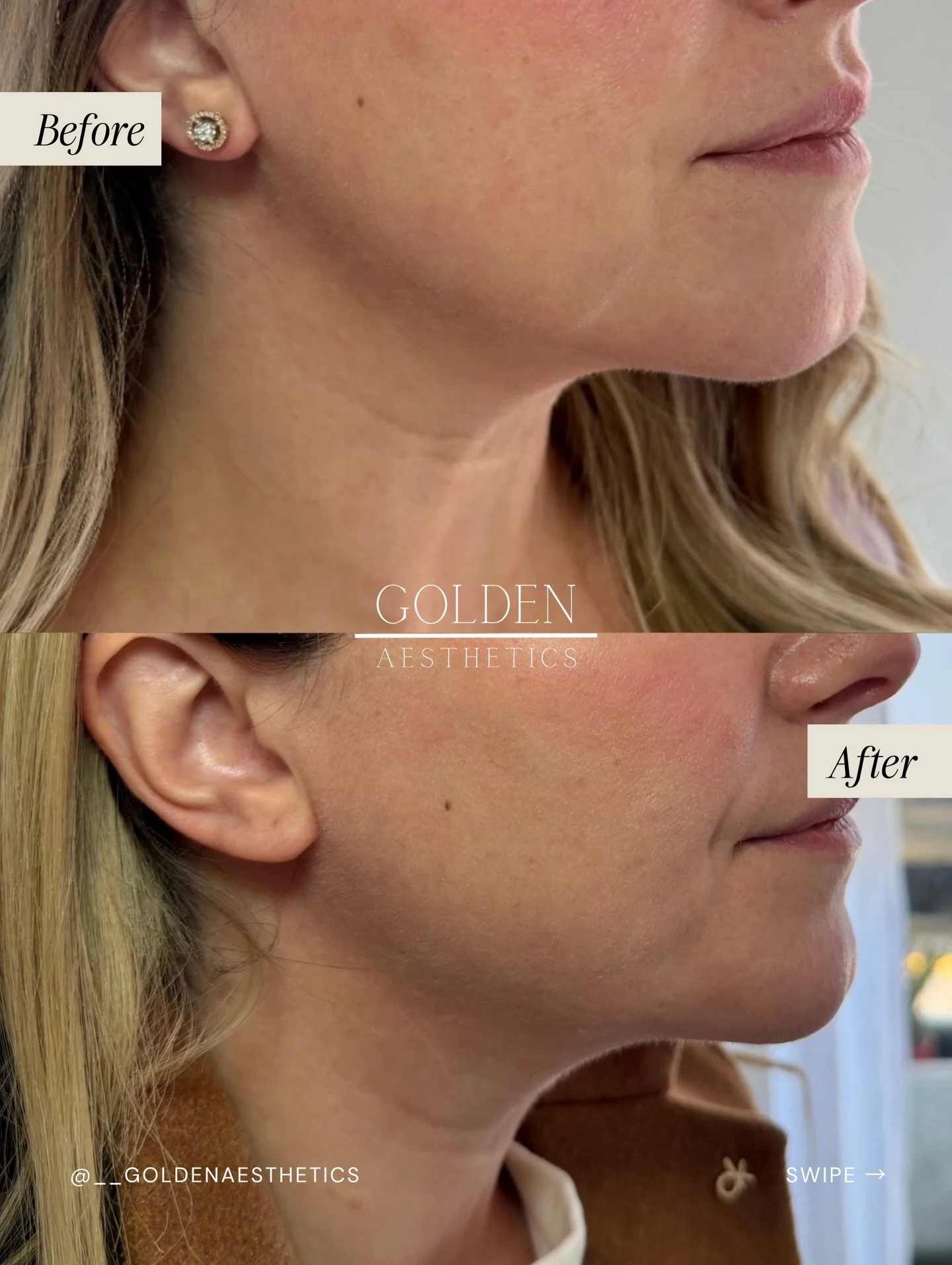 That neck band that shows up the second you talk or smile? Tox can help soften it. Those are platysmal bands, which tend to become more noticeable over time and contribute to jowling.

Tox relaxes that movement, creating a smoother, more refreshed lo