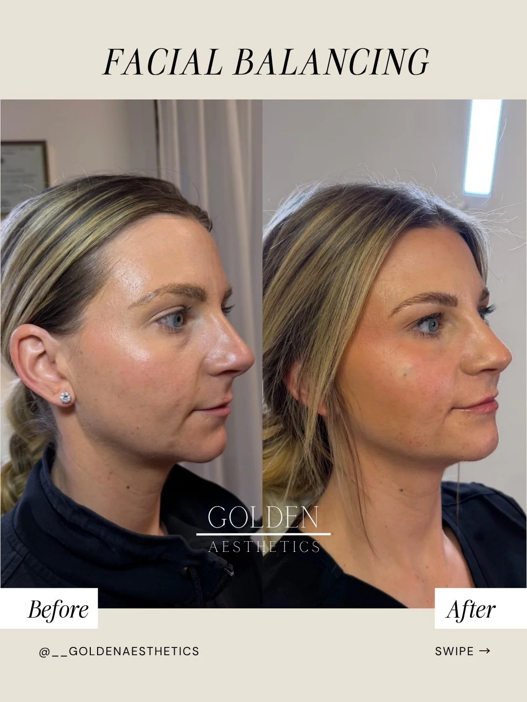 This is what facial balancing actually looks like. No &ldquo;pillow face.&rdquo; She doesn&rsquo;t look &ldquo;done.&rdquo; Just cheekbones that highlight, and a jawline that helps define and support her natural features 🪄

@angie.goldeninjector cam