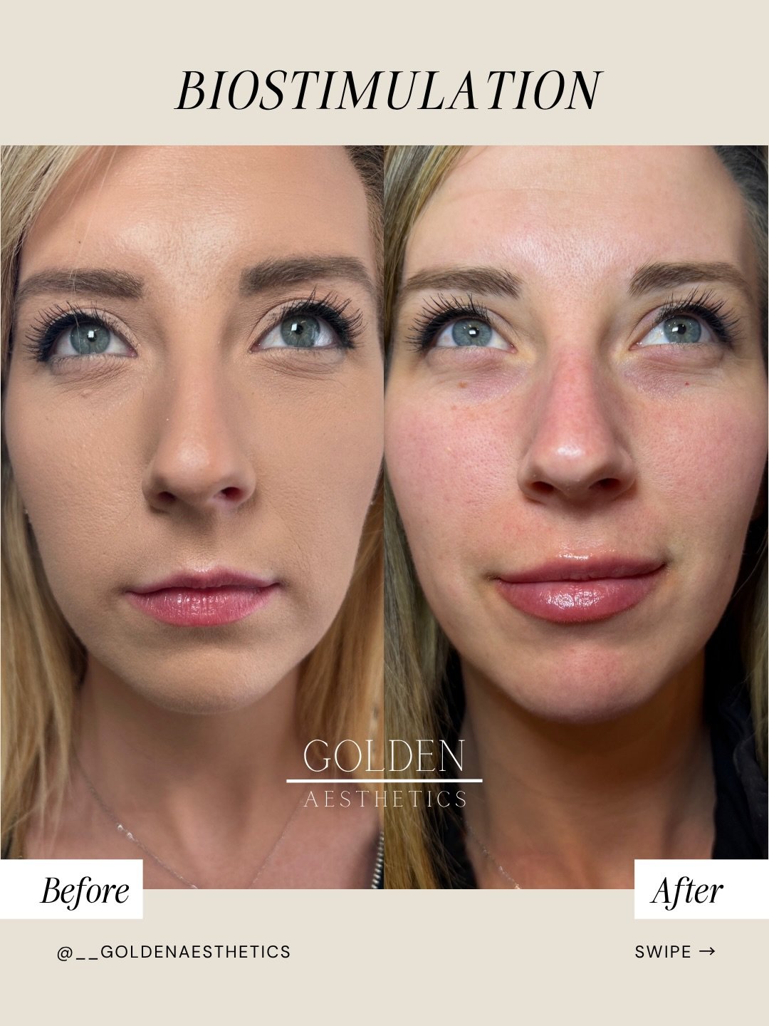 Cheers to feeling better about your bare skin than in makeup, all thanks to Sculptra! 🥂

This is one session, and what you're seeing is her own collagen. Biostimulation works by triggering your body's natural collagen production over time, building 