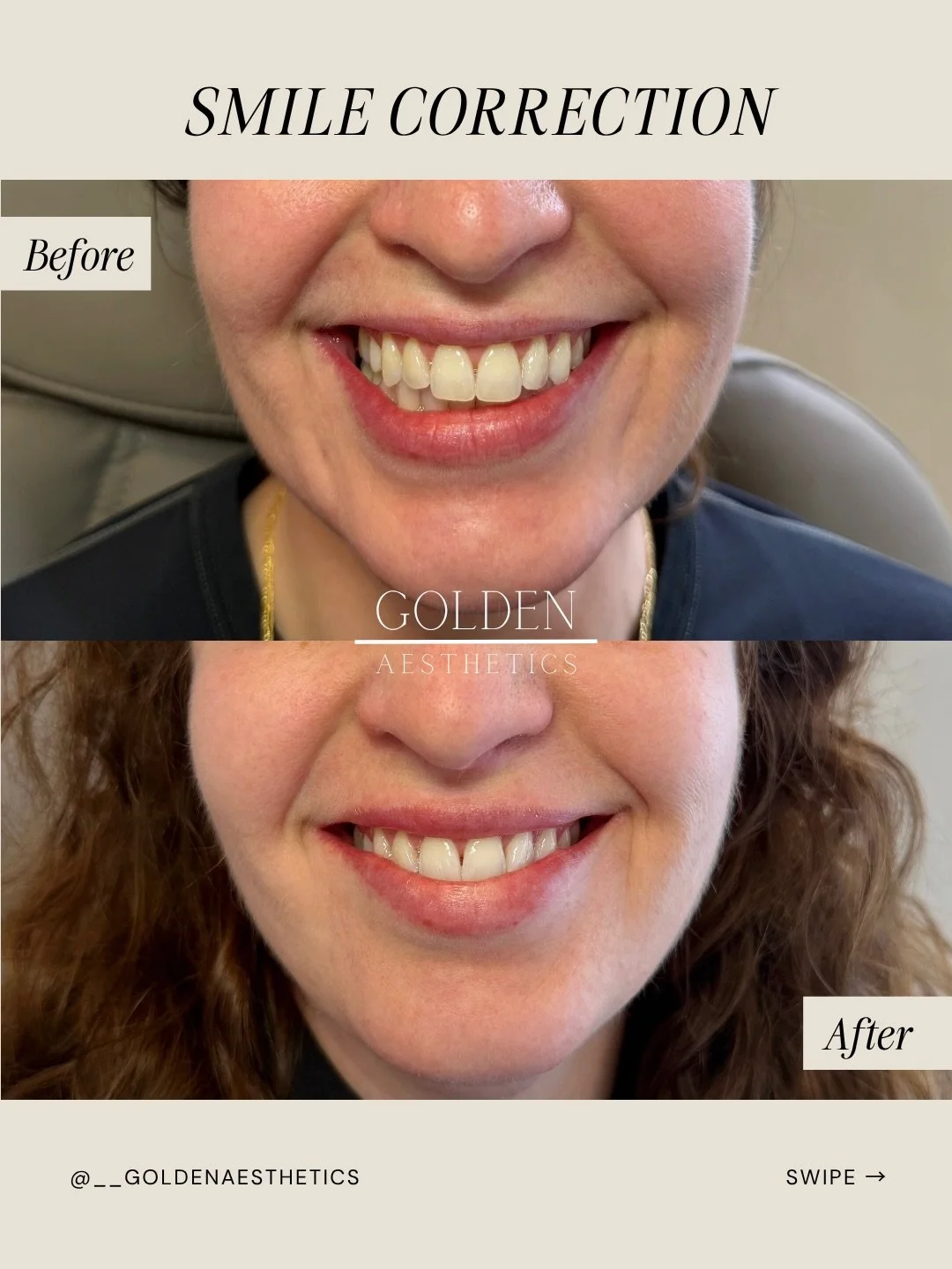 This one is close to my heart because the approach was anything but obvious 🪄

She had been insecure for a long time about how her smile pulled down more on one side, as one of her facial muscles was naturally very strong.

The muscle we targeted is