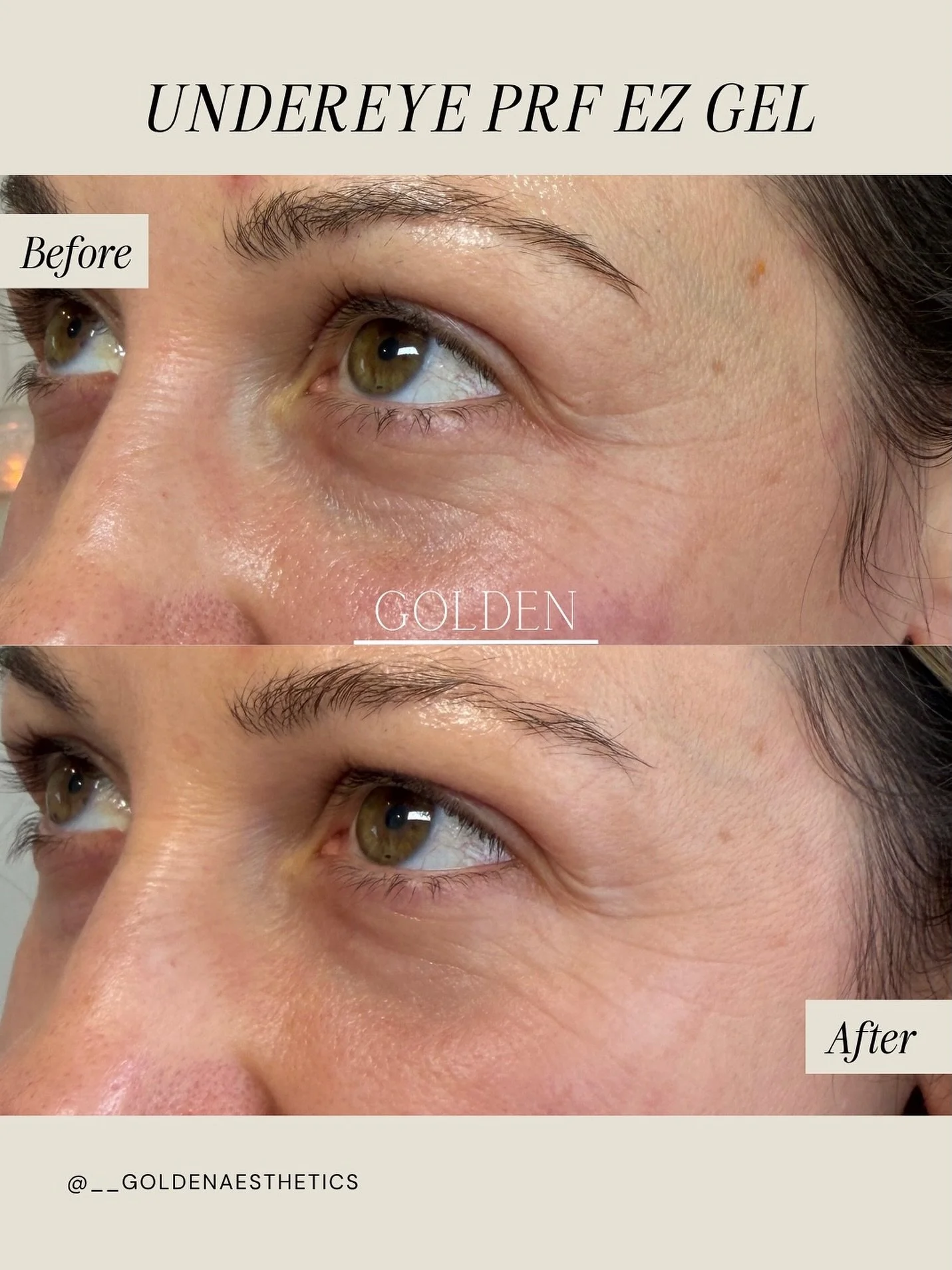 PRF EZ Gel is my favorite treatment for the undereye area, and results like this (just after ONE treatment!) are exactly why. 

EZ Gel is made entirely from your own blood. We draw it, spin it down, and process it into a gel-like substance that gets 