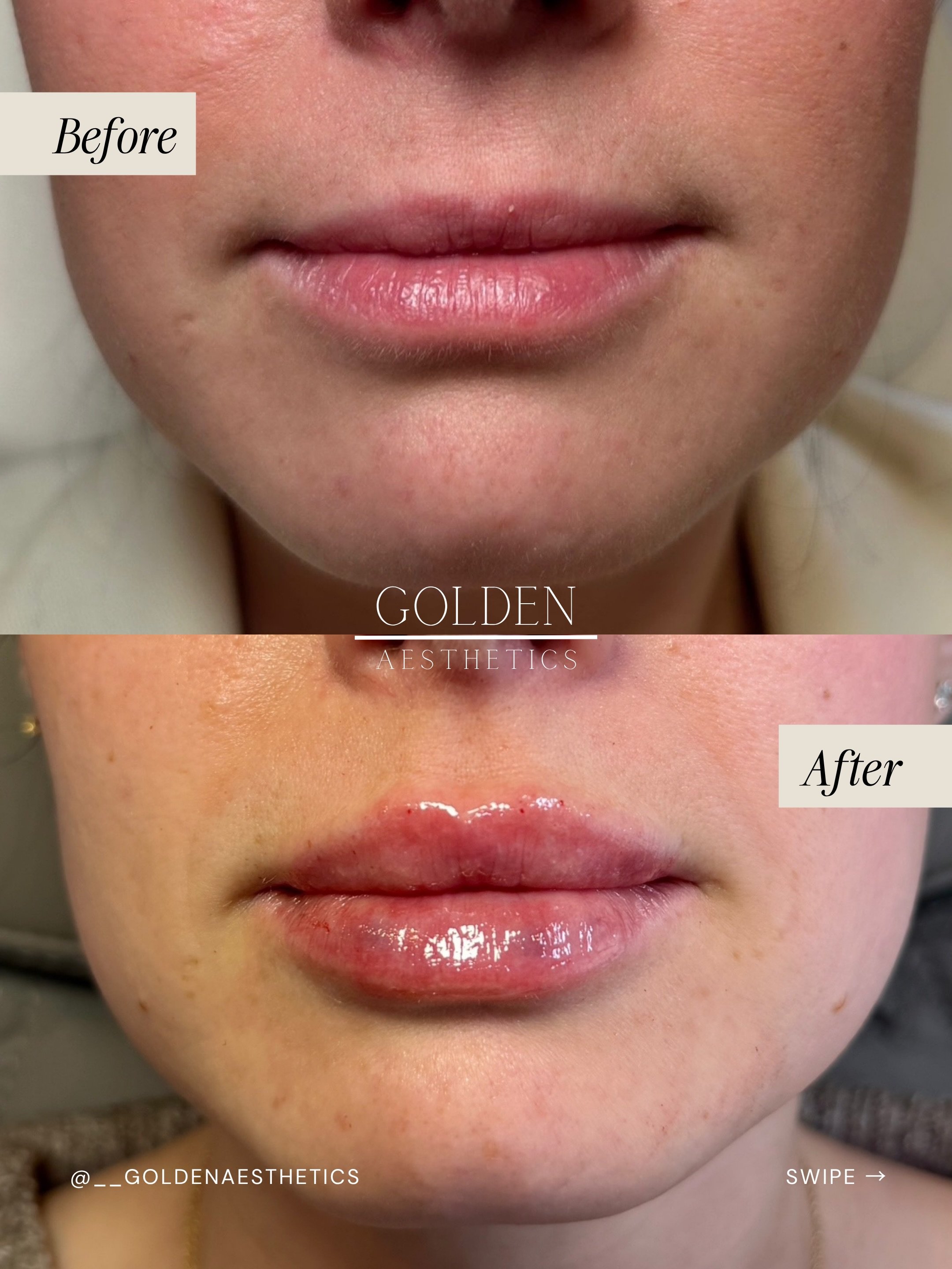 These lips though 🥹🪄

Fuller &amp; more defined, but never overfilled. The kind of result that fits her gorgeous face perfectly *chef's kiss* 

Swipe to slide 4 to see exactly how I mapped this out before a single drop of filler was placed. Good re